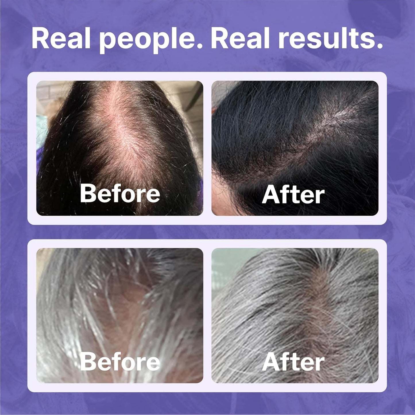 Shapiro MD Women's Hair Regrowth Kit - Shampoo, Conditioner & 2% Minoxidil | Anti-Hair Loss Solution, 1 Month Supply
