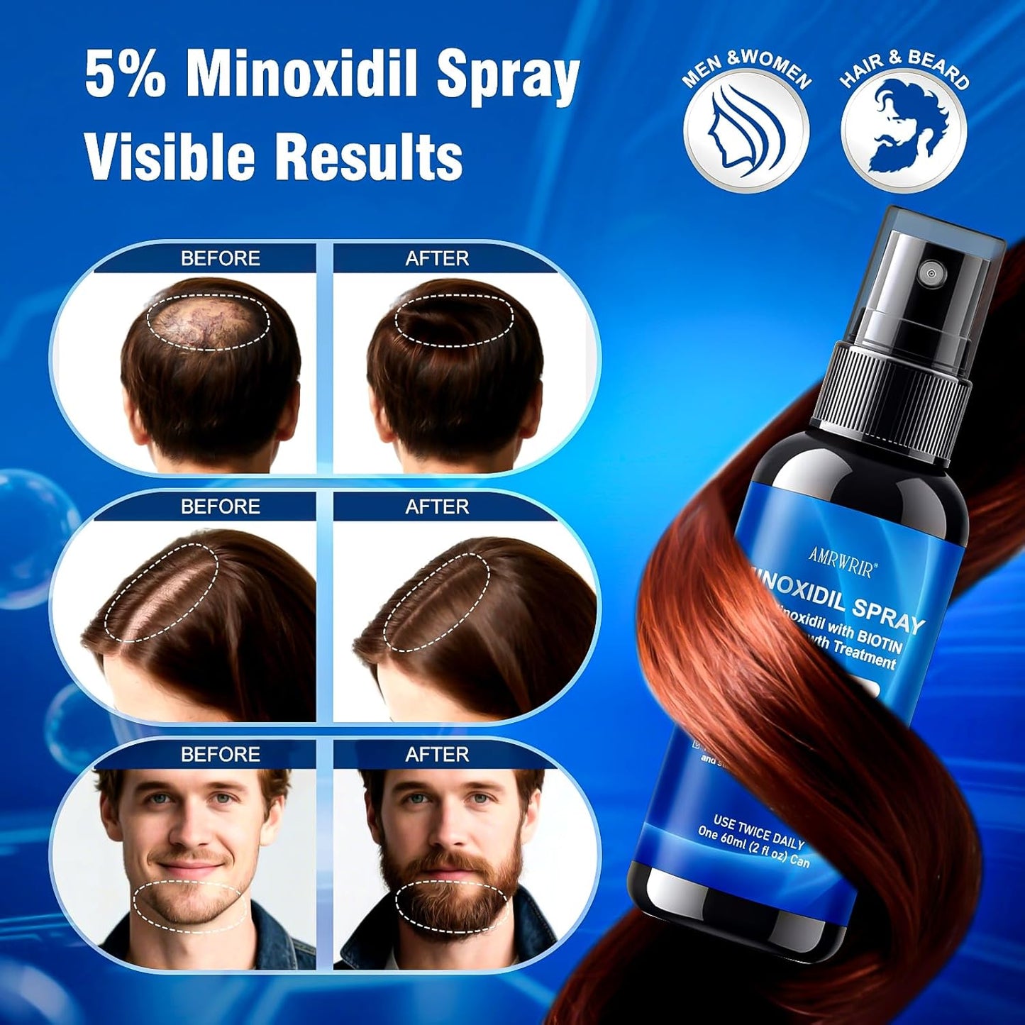 Minoxidil Hair Growth Spray for Men & Women - Biotin Infused Treatment | 6 Pcs, 12 Fl Oz Total