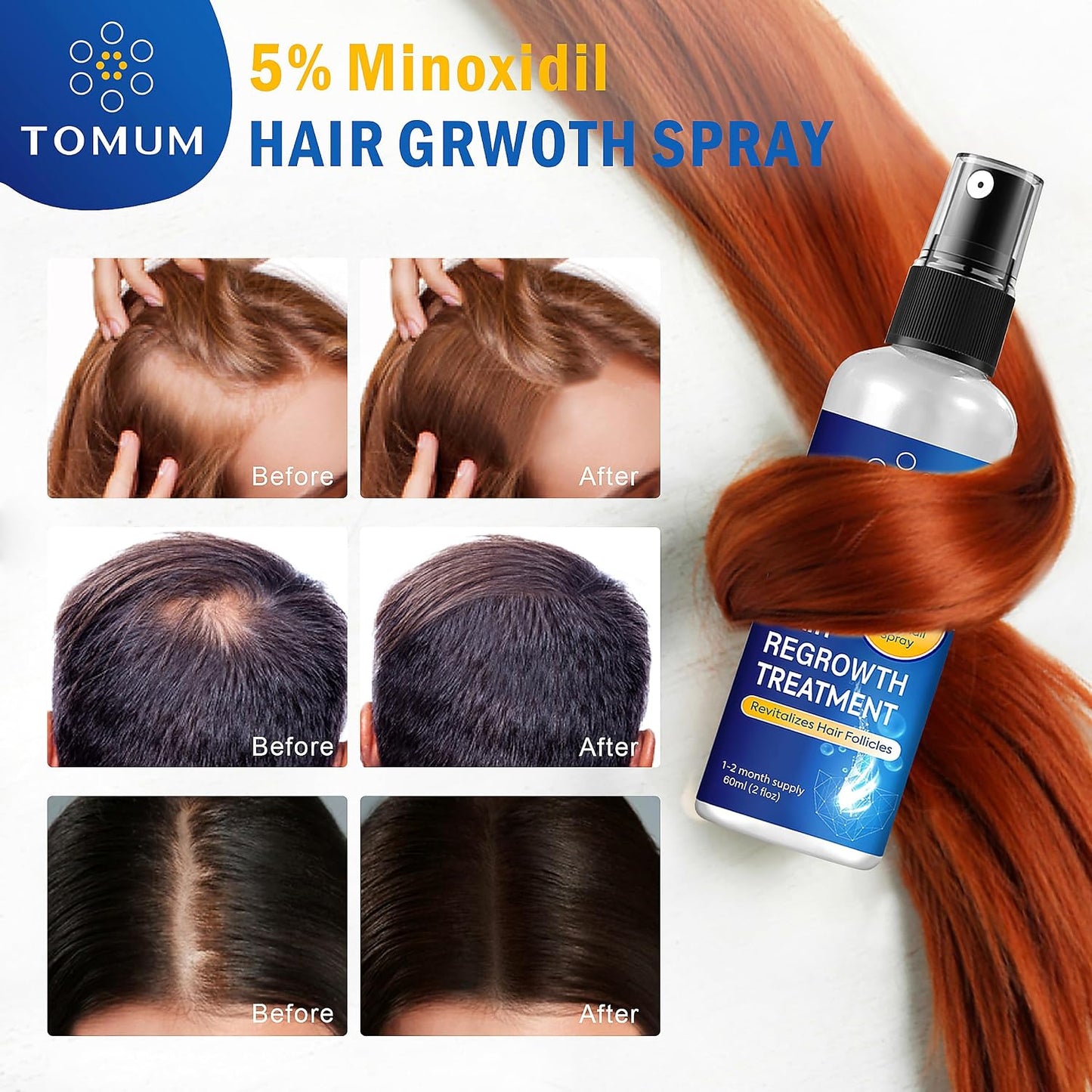 Minoxidil Hair Growth Treatment - 5% Topical Spray for Men & Women | 60ml, 2-Pack for Thicker, Stronger Hair