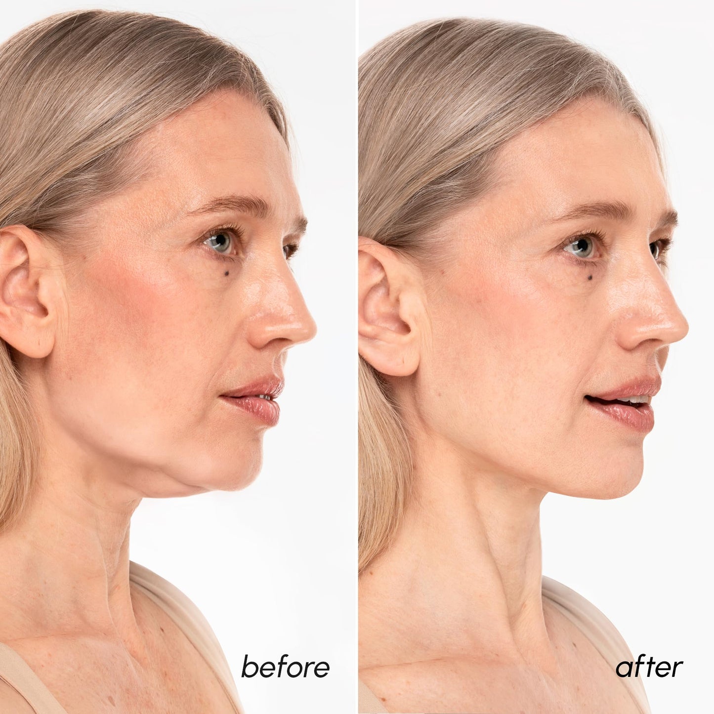 MAREE V Line Lifting Mask with 24K Gold – Deep Collagen Face Mask for Women – Jawline Shaper Mask with Retinol & Hyaluronic Acid – Neck Tightening & Firming – Double Chin Strap for Face Lift