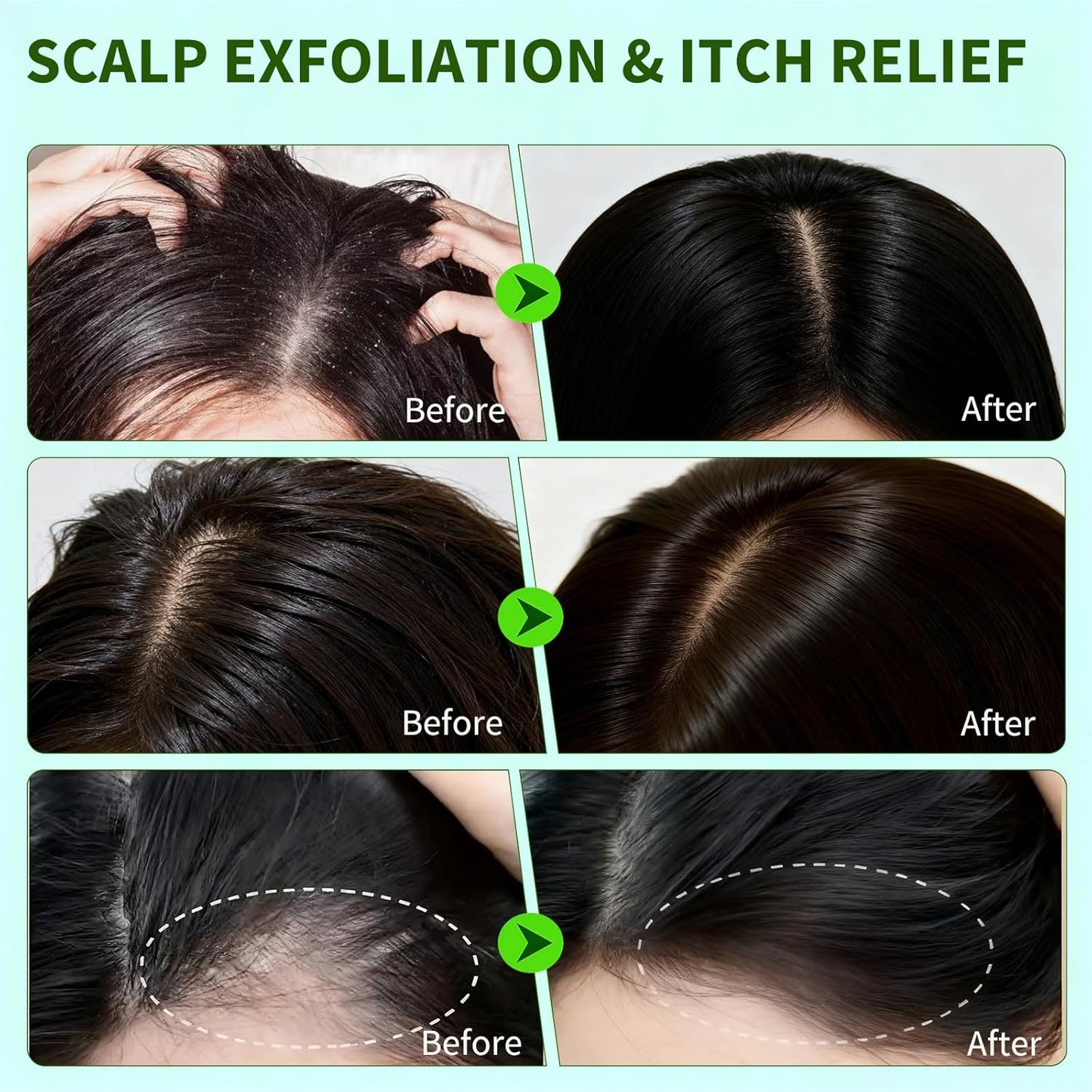 Scalp Scrub Exfoliator - Rosemary & Mint Hair Treatment for Itchy Scalp | 8.8oz Clarifying Shampoo with Massager