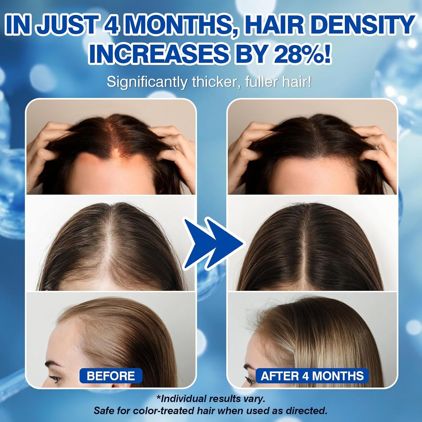 5% Minoxidil Hair Growth Spray Serum for Women | Fast-Acting Formula