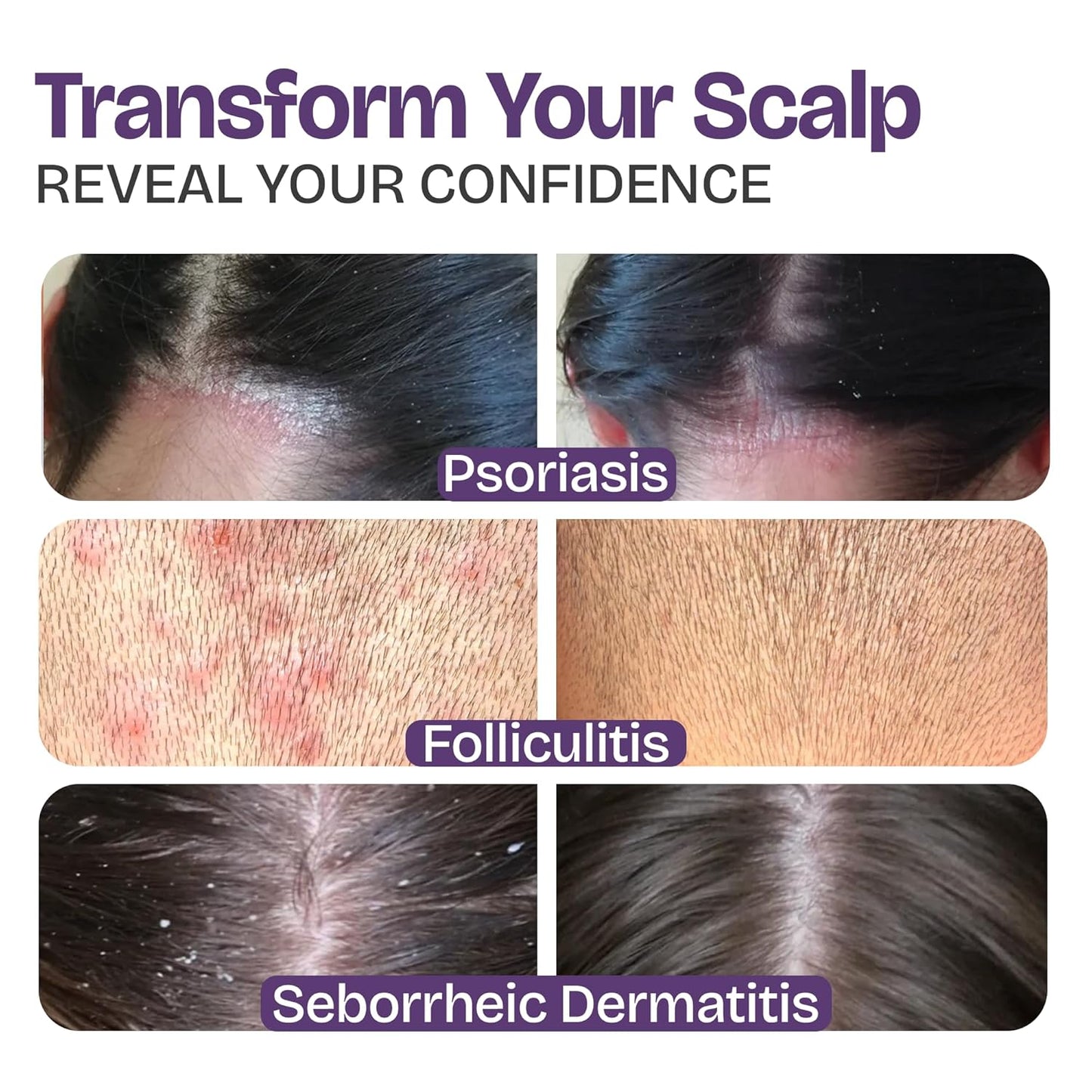Psoriasis Shampoo - Antifungal Treatment for Eczema, Folliculitis & Seborrheic Dermatitis | Manuka Honey Formula