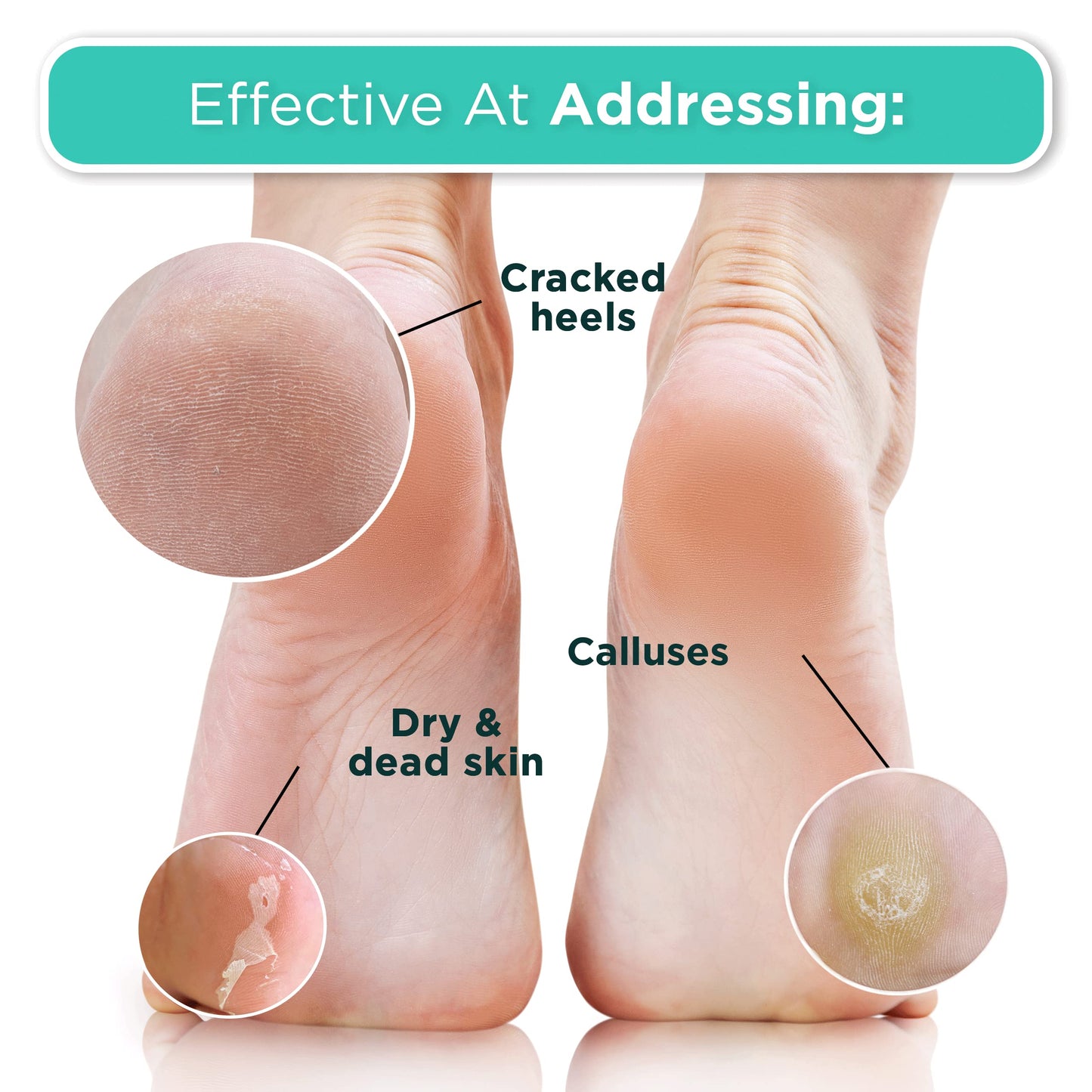 DERMORA Foot Peel Mask - Exfoliating Foot Peeling Mask for Dry, Cracked Feet, At-Home Spa Care, Callus Removal & Smoother Skin Result, 2 Pairs Regular Size (Fits up to Woman 11, Men 10) Original Scent