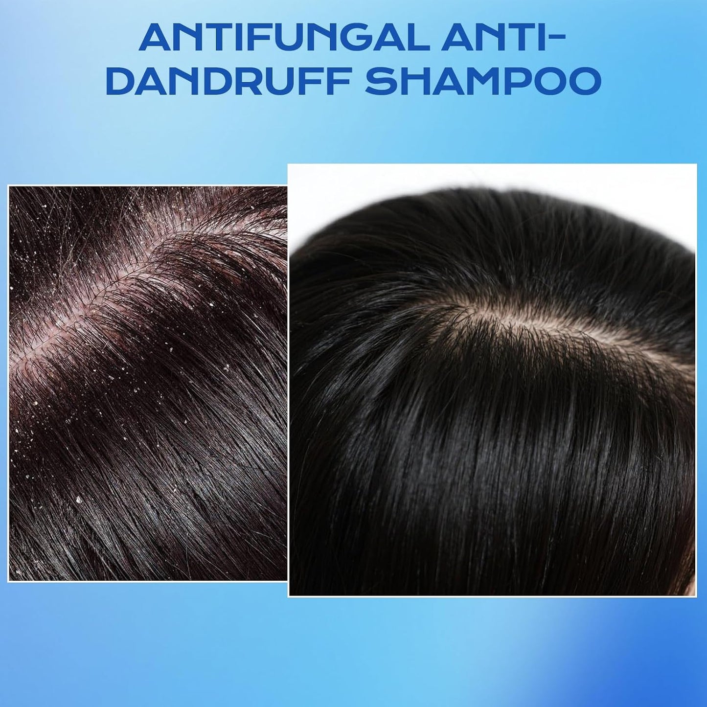 Ketoconazole Anti-Dandruff Shampoo - Scalp Treatment for Seborrheic Dermatitis & Psoriasis | Itchy Scalp Relief, Hydrating Care for All