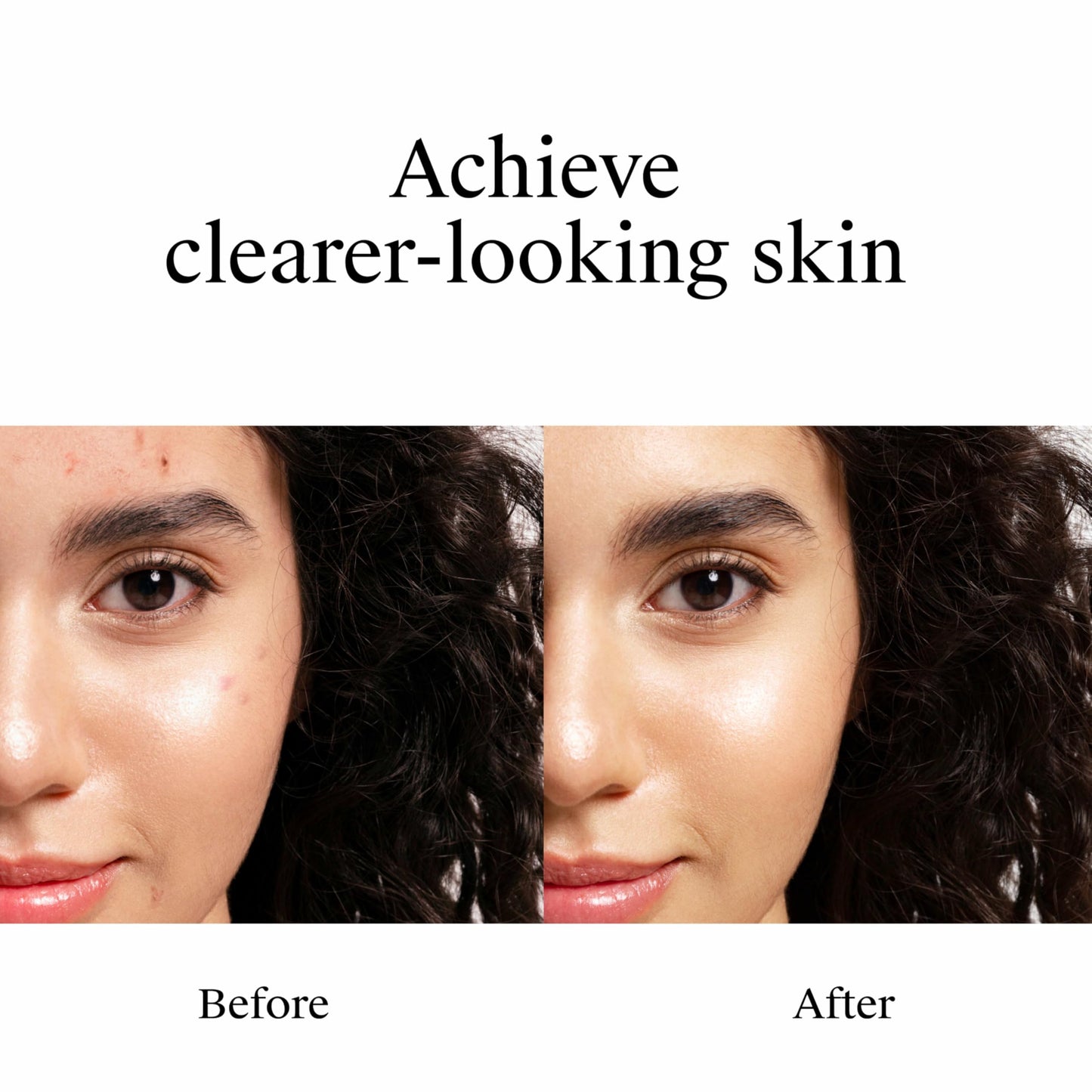 Neutrogena Rapid Clear Stubborn Acne Spot Treatment Gel, Maximum Strength 10% Benzoyl Peroxide Treatment Medication for Acne Prone Skin, Pimple Cream Reduces Size & Redness, 1 oz
