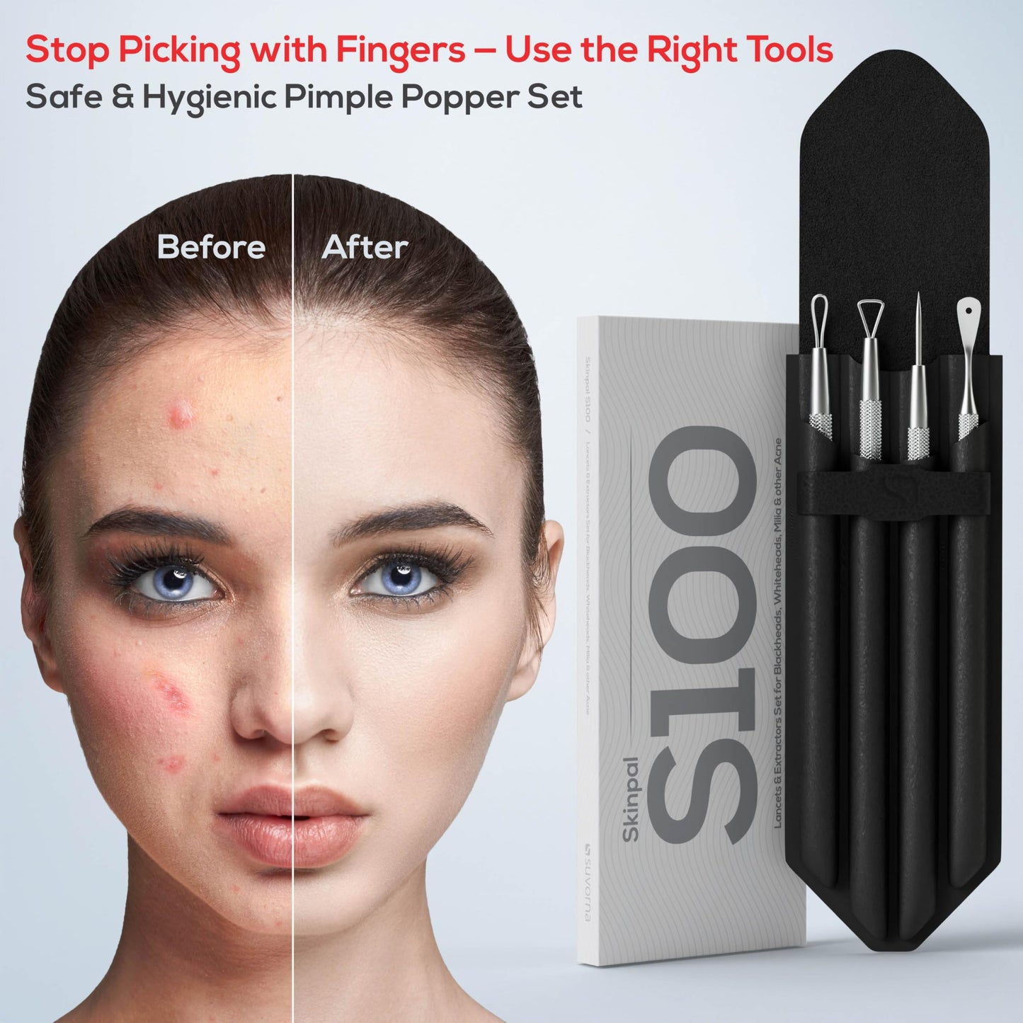 Suvorna Pimple Popper Tool Kit & Milia Remover, 4-Piece Stainless Steel Blackhead Extractor, Whitehead & Comedone Extractor with Lancets for Facial Extraction