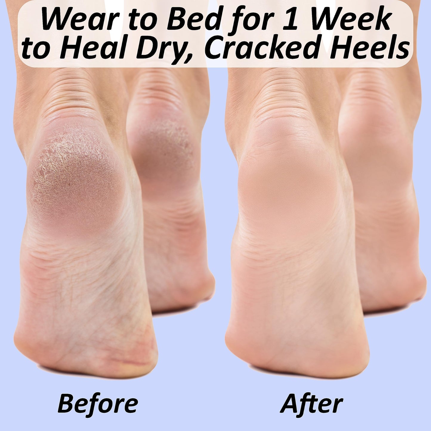 Moisturizing Socks for Cracked Heel Treatment: Socks for Cracked Heel Repair, Silicone Toeless Socks, Spa Gel Socks for Dry Cracked Feet Women, Lotion Moisture Pedicure Socks