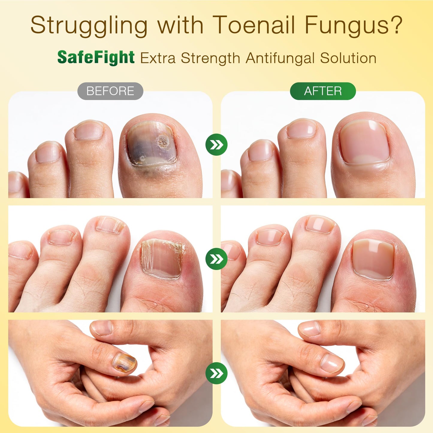 Toenail Fungus Treatment with 25% Undecylenic Acid & Tolnaftate, SafeFight Nail Repair Solution for Fungi Nail, Toenail Fungus Treatment Extra Strength Nail Repair for Fungi Nail