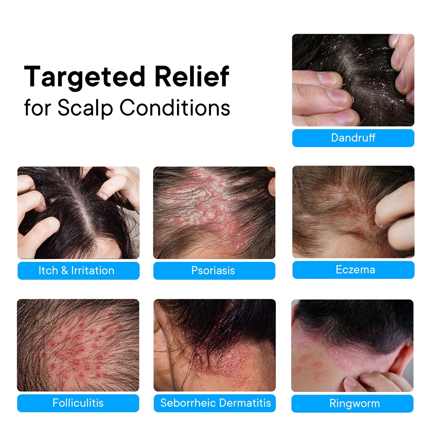 ProBliva Psoriasis Scalp Care System