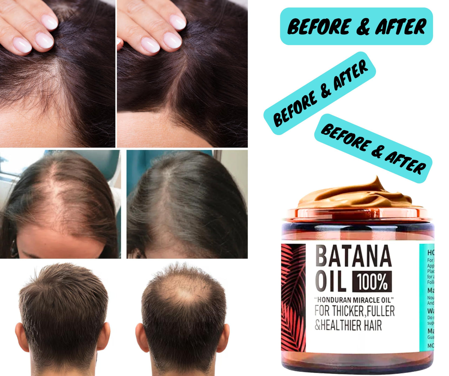 Batana Hair Growth Oil, Supports Regrowth, Penetrates Shaft To Repair And Strengthen, 100% Raw Unrefined, Nourishes, Reduces Breakage & Stronger, Longer Hair