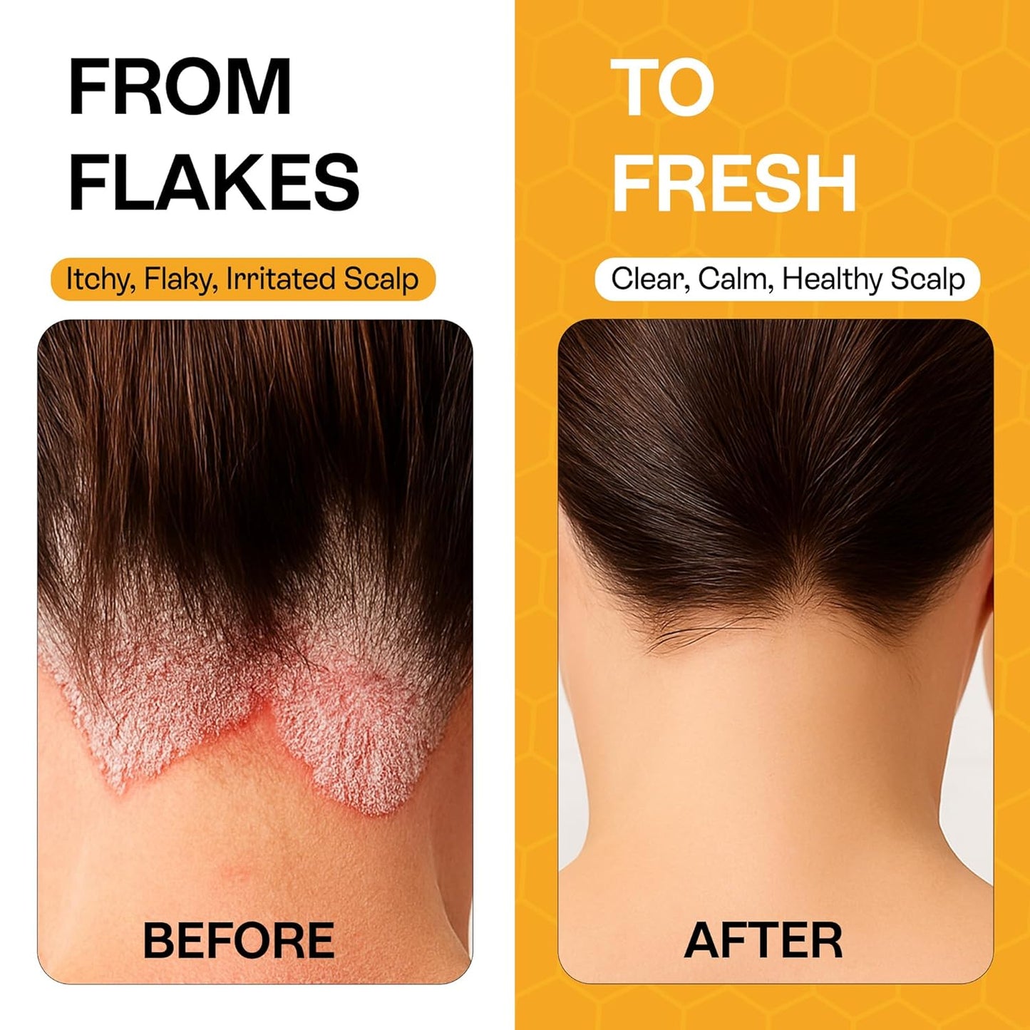 Psoriasis Shampoo with Salicylic Acid 3% - Dry & Itchy Scalp Treatment for Eczema Relief | 6.76 Fl Oz (Pack of 2)