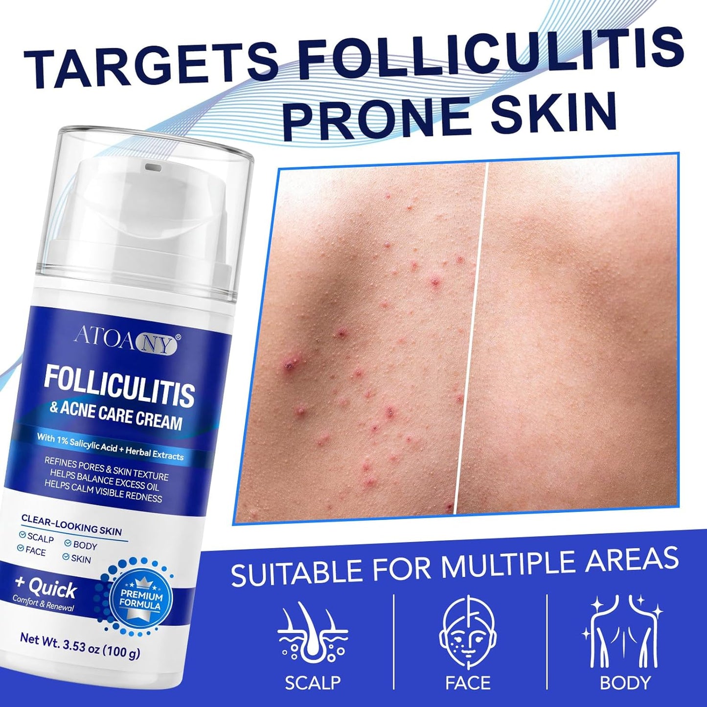 Folliculitis Treatment Cream - 1% Salicylic Acid for Scalp, Face & Body | Soothing Moisturizer for Sensitive Skin, 100g
