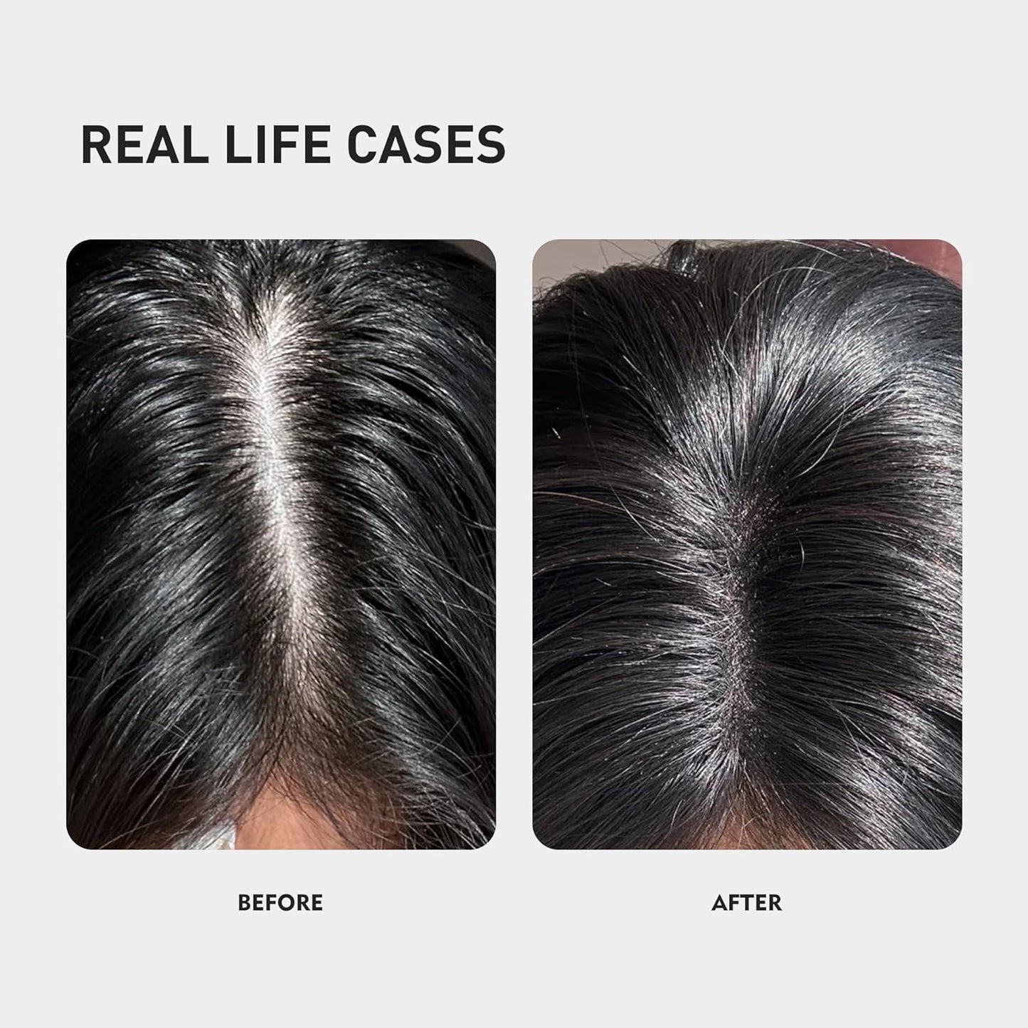 KINTOR KX-826 Hair Growth Spray - 0.5% Formula for Oil Control & Regrowth | 60ml
