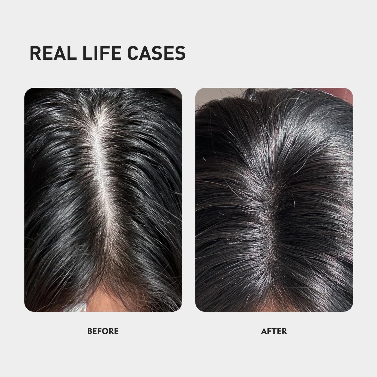 KINTOR 0.5% KX-826 Hair Growth Spray DHT Blocker Hair Regrowth Products,Nourish Hair follicles,Hair Oil Control Products For Men&Women-1 Month Supply 60ml
