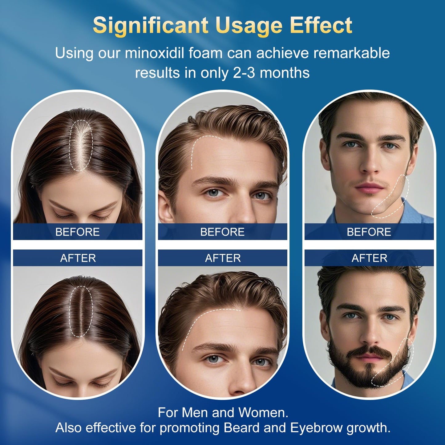 5% Minoxidil Foam 5 PCS for Men - Infused with Biotin, Hair Regrowth Treatment for Longer, Fuller Hair and Beard (5-6 Month Supply)