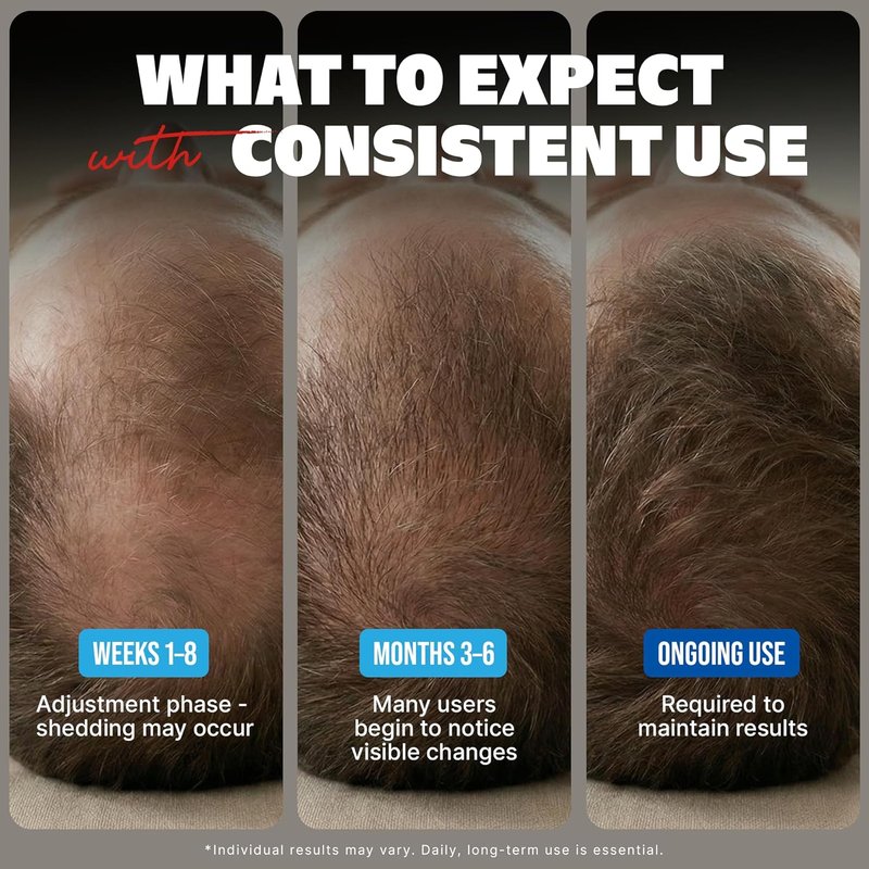 Kirkland Minoxidil for Men - Extra Strength 5% Hair Regrowth Treatment | 6-Month Supply with Upgraded Dropper