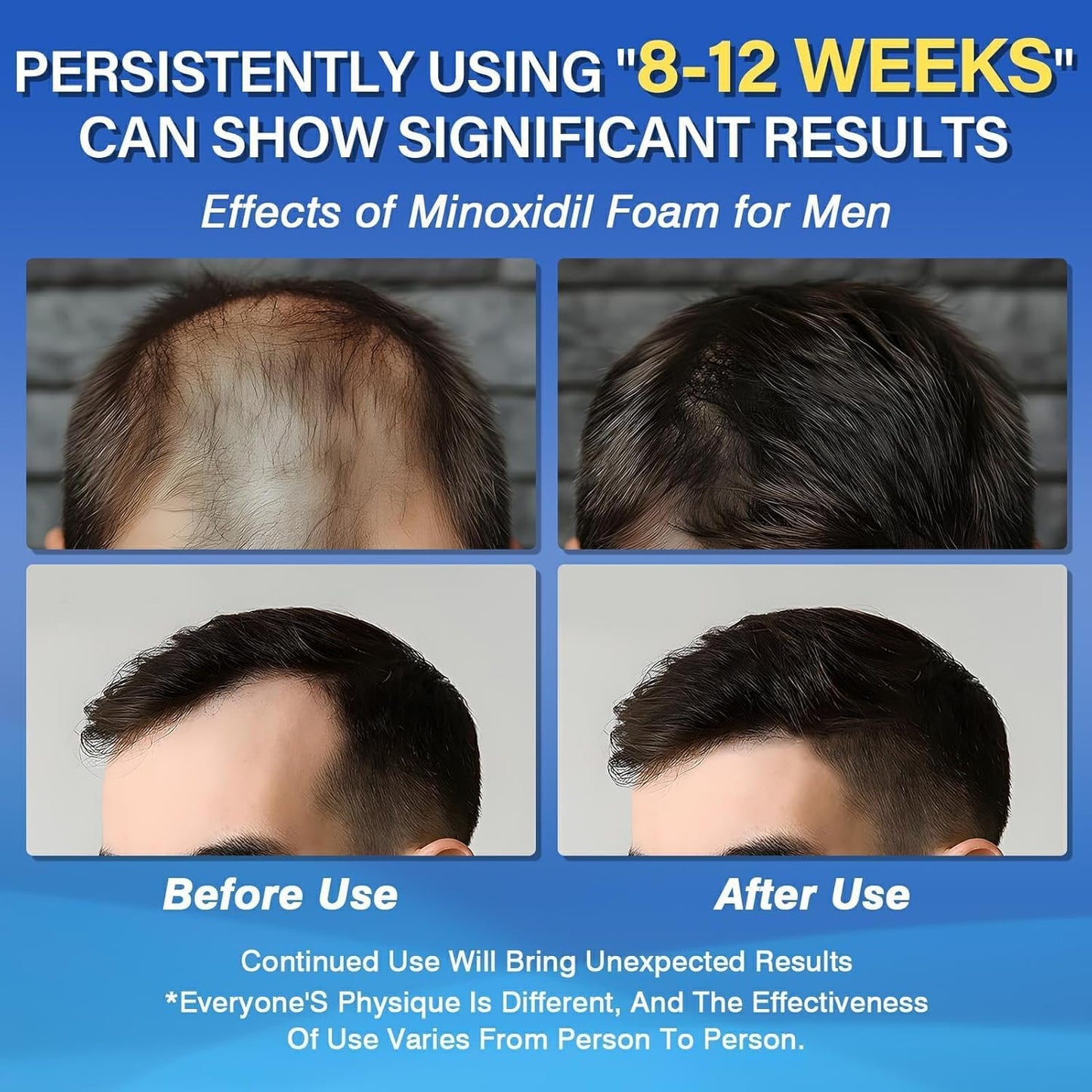 Minoxidil 5% Foam for Men Hair Growth
