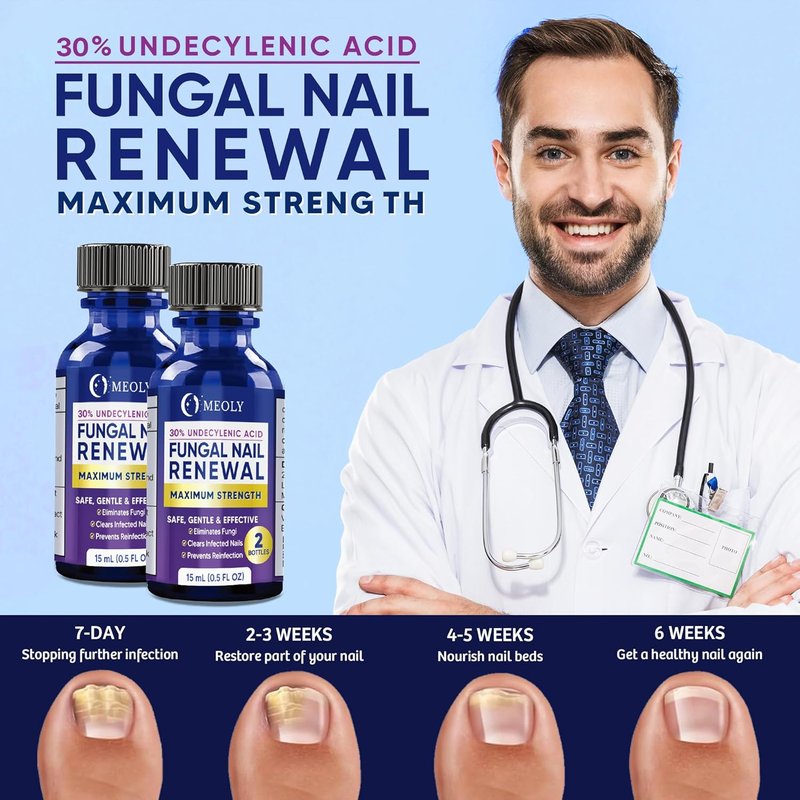 Toenail Fungus Treatment - 30% Undecylenic Acid with Natural Oils | Includes Nail Bandage, File & Brush for Ingrown Nails