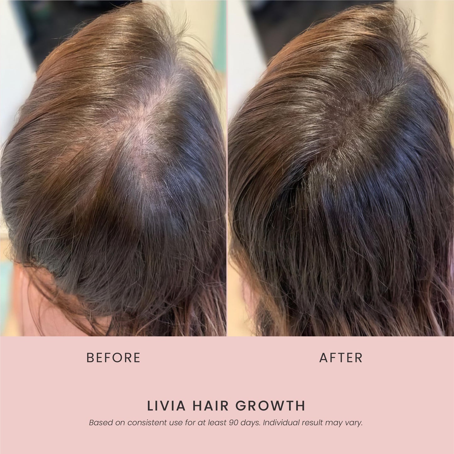 LIVIA Hair Growth Serum – Advanced Hair Strengthening & Regrowth Formula – Reduces Shedding, Hair Loss & Breakage – Nourishes Scalp, Promotes Thicker, Fuller & Healthier Hair– 30ml