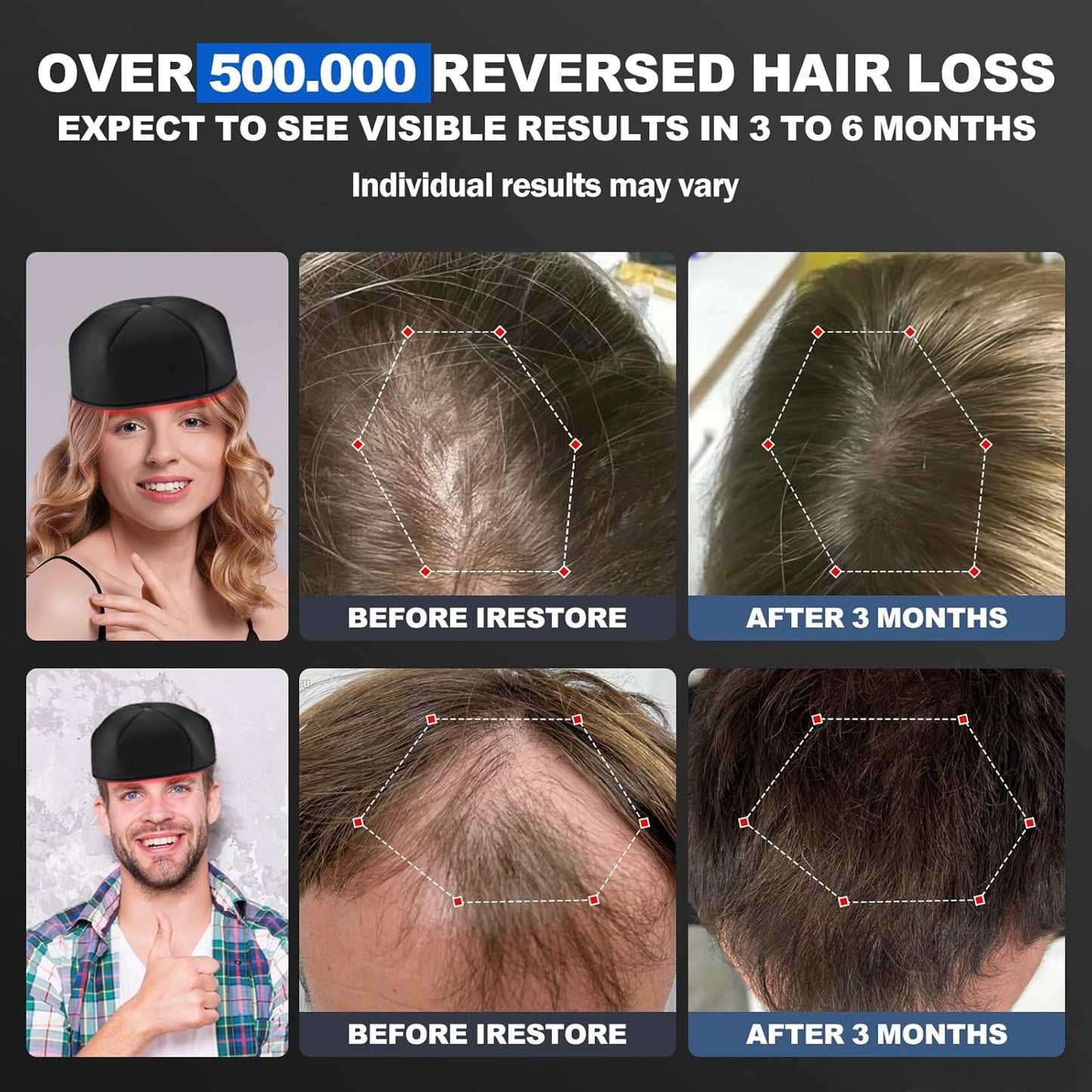Laser Cap - FDA Cleared Red Light Therapy for Hair Growth | Full Scalp Coverage, 650nm Wavelength