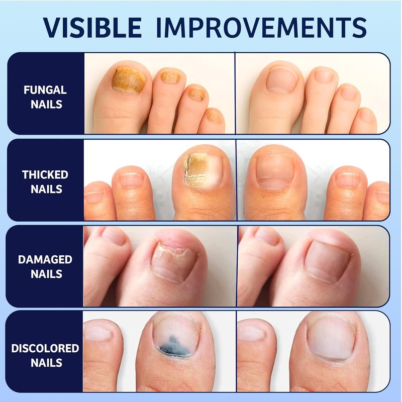 Toenail Fungus Treatment - 30% Undecylenic Acid with Natural Oils | Includes Nail Bandage, File & Brush for Ingrown Nails