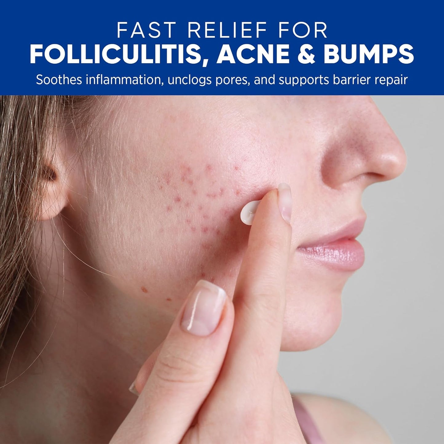 Folliculitis & Acne Treatment Cream - Salicylic Acid & Herbal Extracts for Scalp, Face, Body | Soothes Irritated Skin, 100g