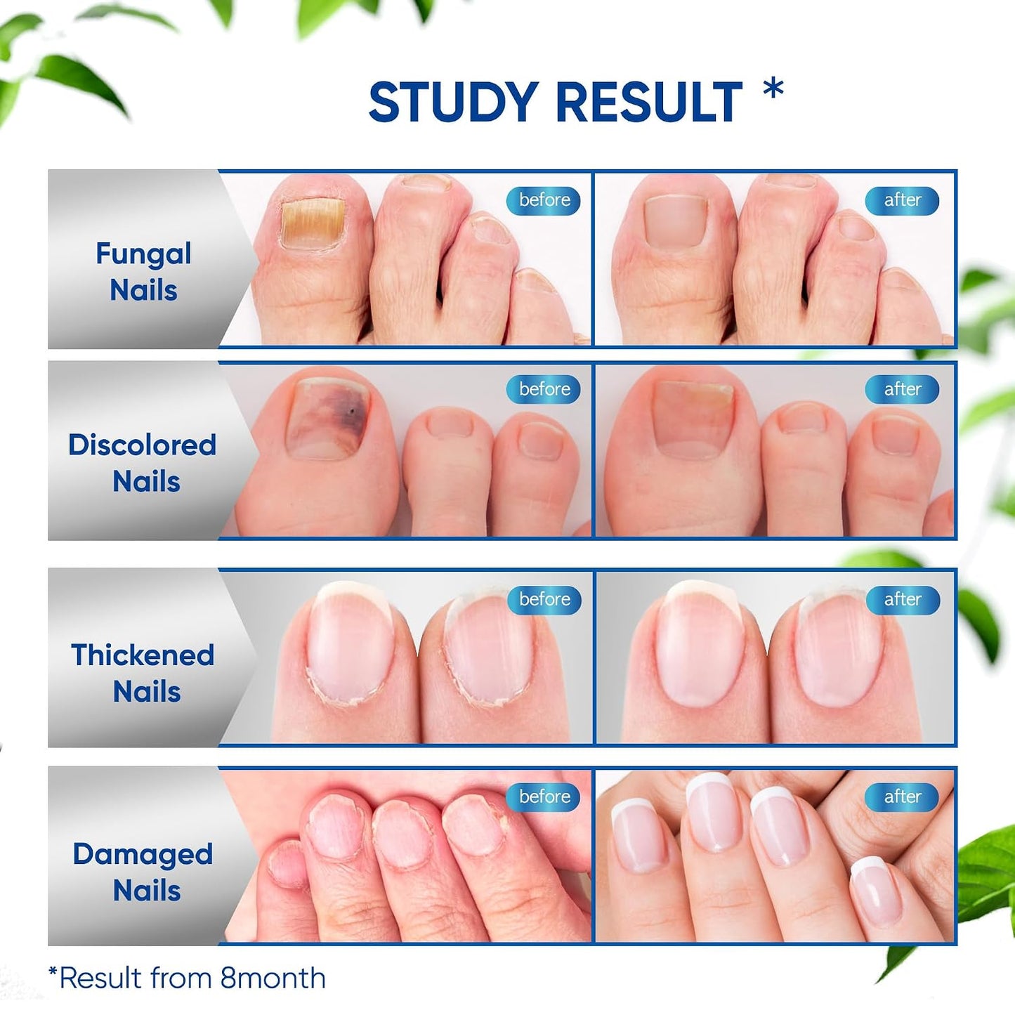 Maximum Strength Toenail Fungus Treatment - Antifungal Solution with Undecylenic Acid for Thick, Brittle Nails | 30ml