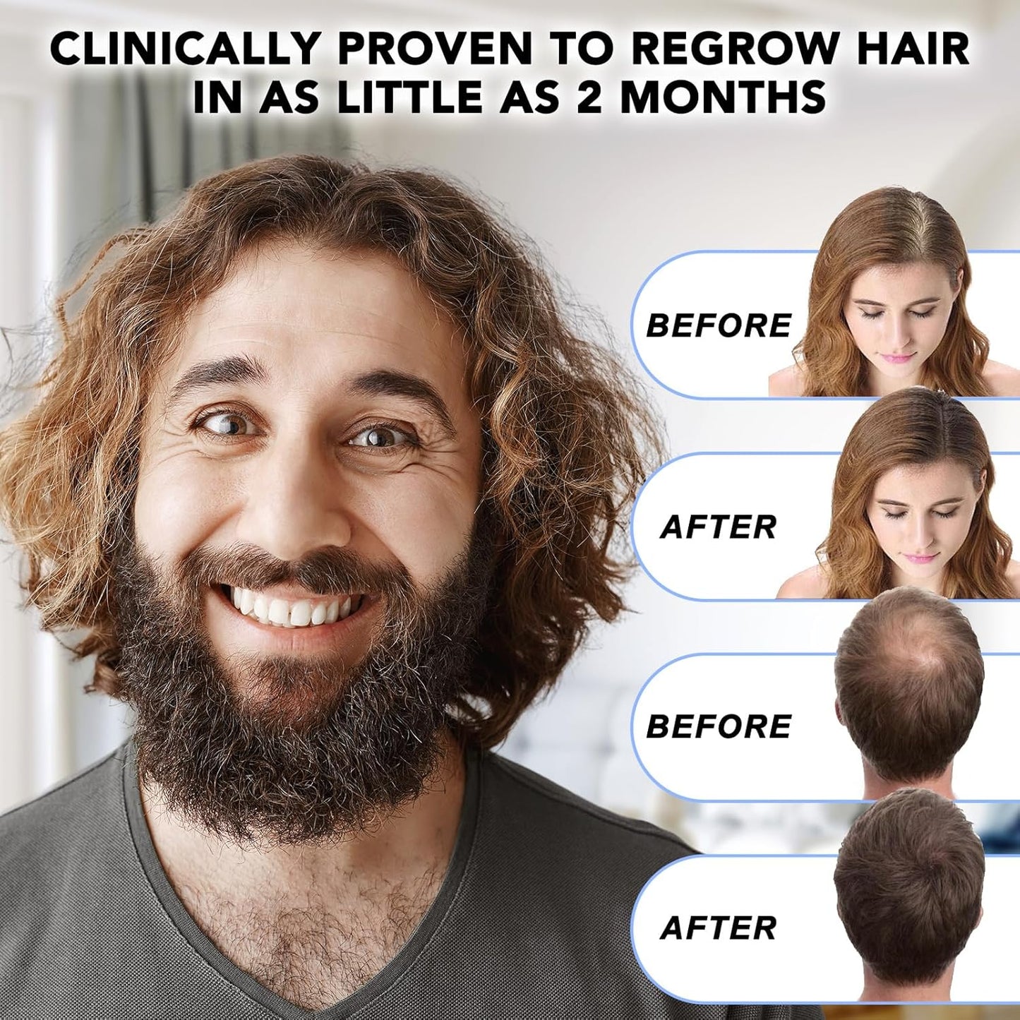 Minoxidil for Men - 5% Extra Strength Hair Regrowth Treatment | Topical Solution with Dropper Applicator