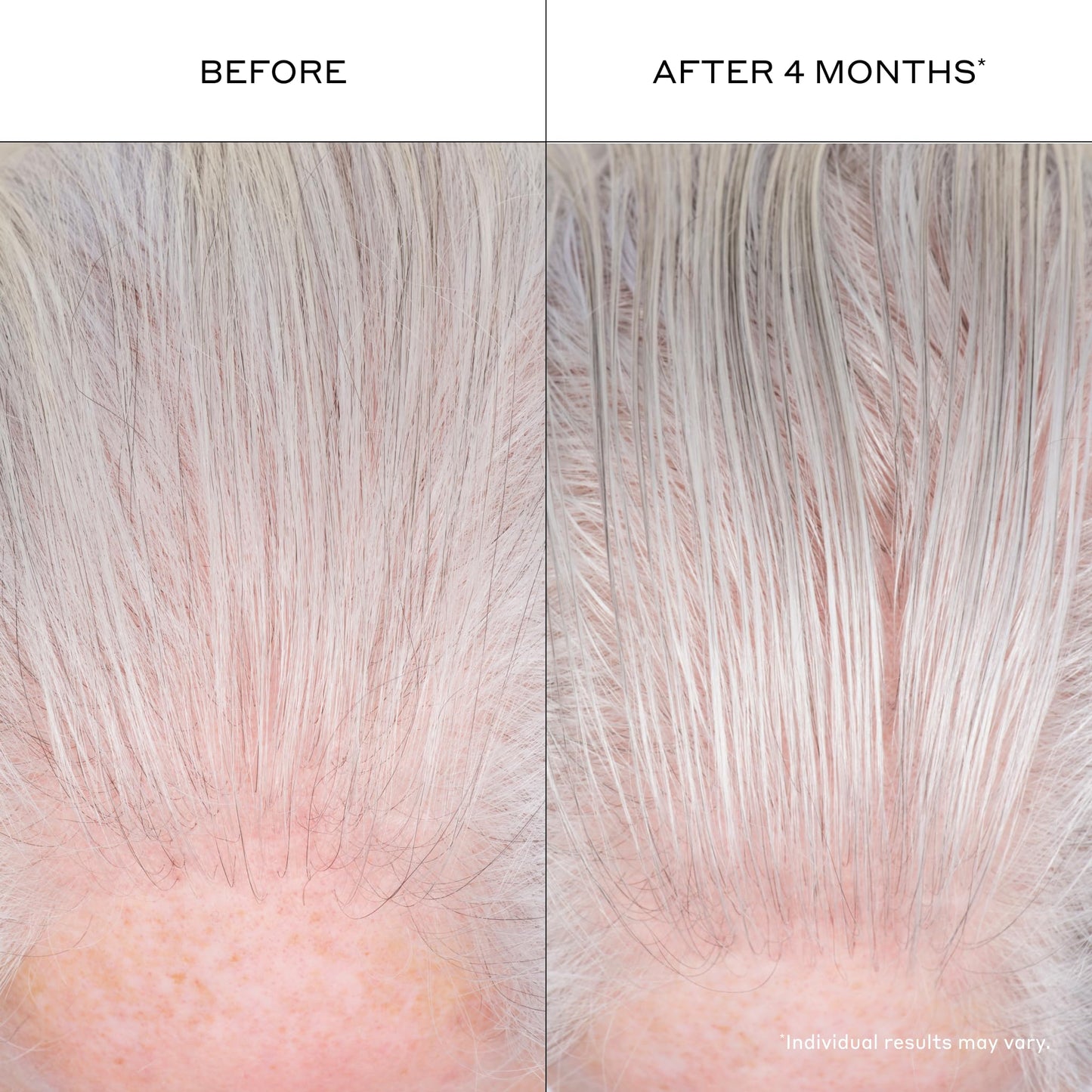 Zenagen Densifying Hair Serum | Boosts Hair Density 3.4 Fl Oz