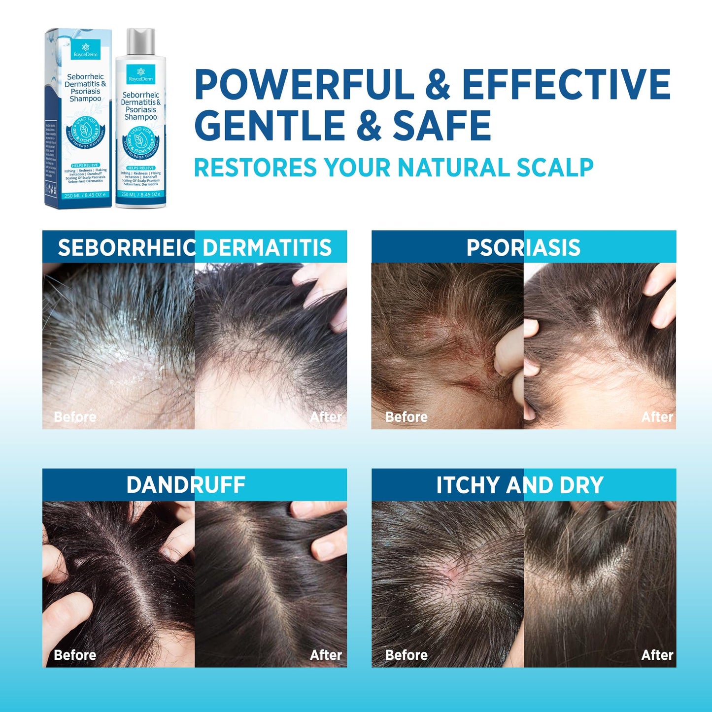 Roycederm Seborrheic Dermatitis & Psoriasis Shampoo and Conditioner Set - Effective Scalp Treatment for Folliculitis, Psoriasis, Dandruff, Dry Itchy Scalp - Soothing, Moisturizing Herbal Formula
