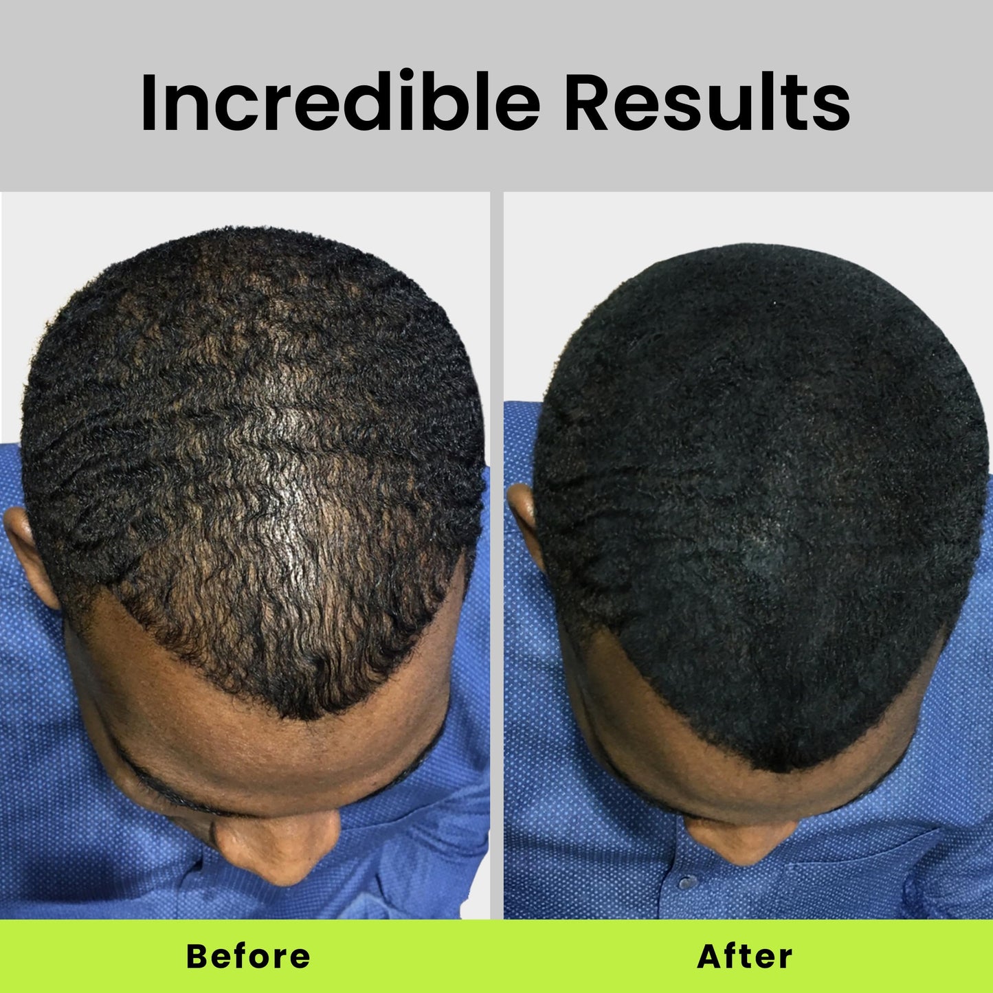 ECLIPSE Hair Fibers Medium Brown for Thinning Hair for Women & Men to Conceal Hair Loss in 15 Seconds - 100% Undetectable Hair Building Fibers, 15g
