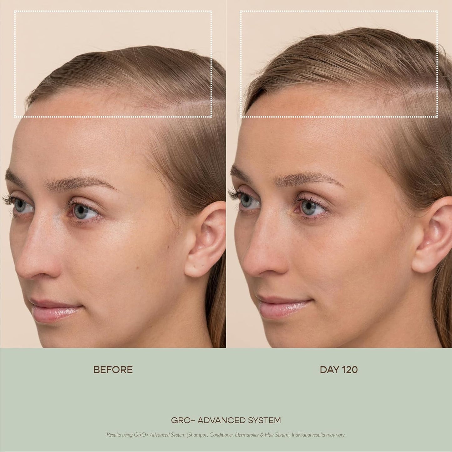 VEGAMOUR GRO+ Advanced Dermaroller - 1,200 Microneedle Scalp Tool | 0.25mm for Gentle Exfoliation & Maximum Coverage