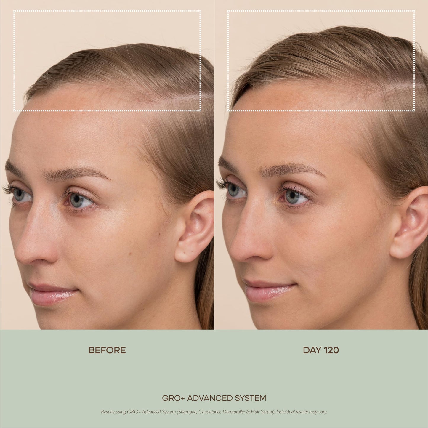 VEGAMOUR GRO+ Advanced Dermaroller | 1,200 Microneedle 0.25mm Scalp Tool | Gently Exfoliates the Scalp | Wide Head for Maximum Coverage