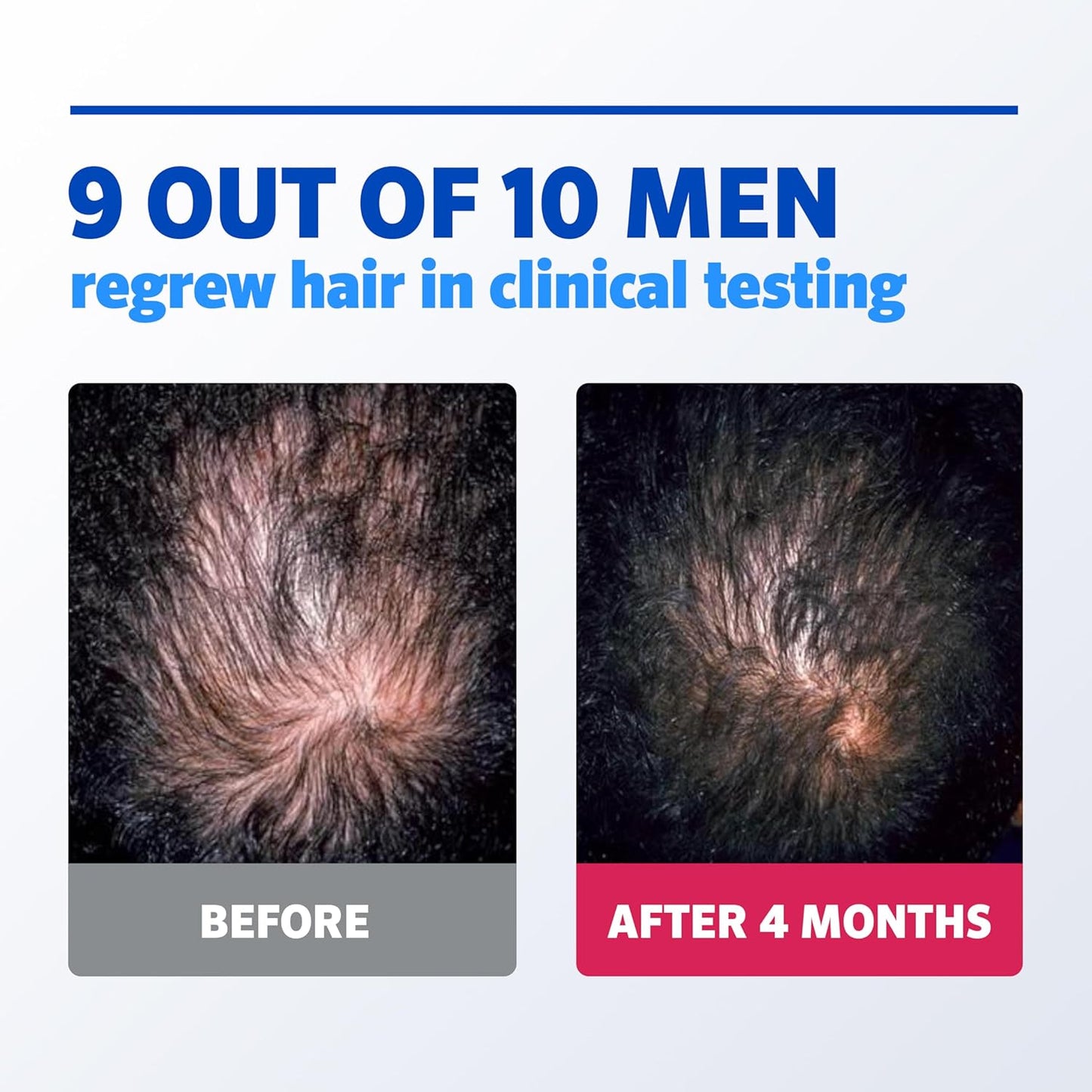 Men's Rogaine 5% Minoxidil Foam - Hair Regrowth Treatment for Thicker Hair | Unscented, 2.11 oz