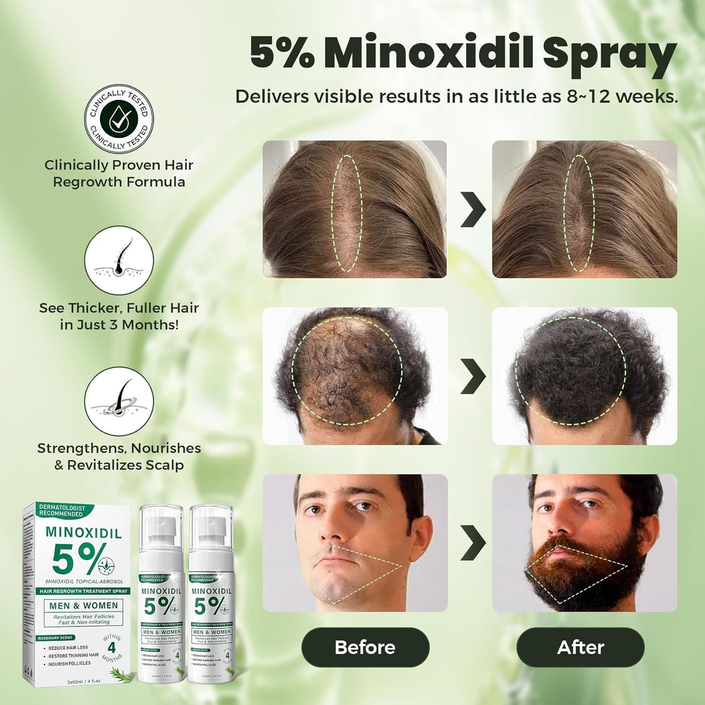 Minoxidil Hair Regrowth Spray - Rosemary Scented Formula for Men & Women | 2 x 60ml Value Pack for Thinning Hair