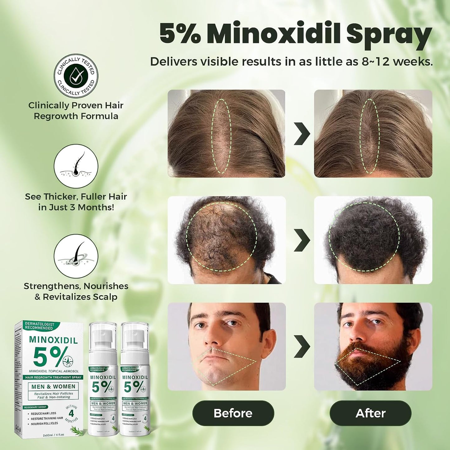 Minoxidil Hair Regrowth Spray for Men & Women - Rosemary Scent | 2 x 60ml Value Pack for Thinning Hair & Receding Hairline