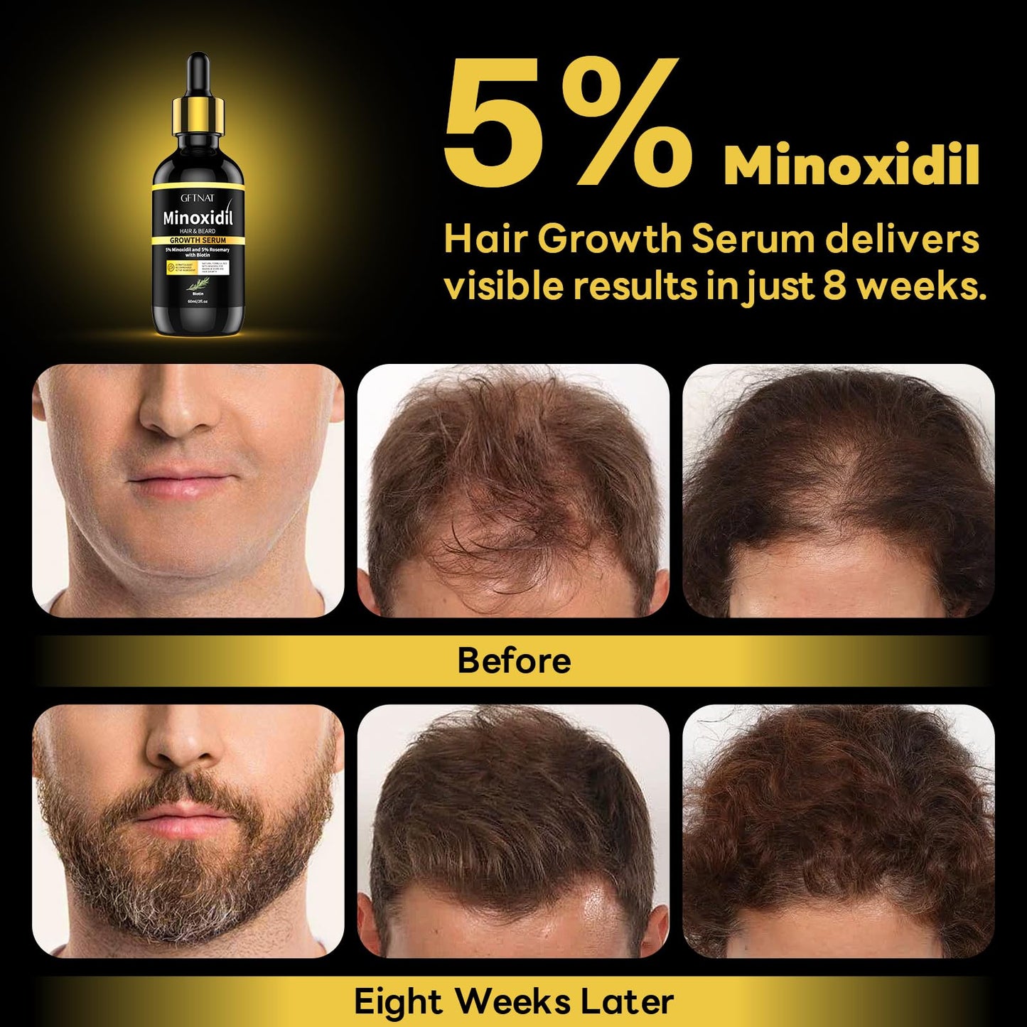5% Minoxidil with Rosemary for Men and Women Hair Growth,Beard Growth Kit,Scalp Serum for Thicker Fuller Hair - 1.9 FI Oz (Pack of 2)