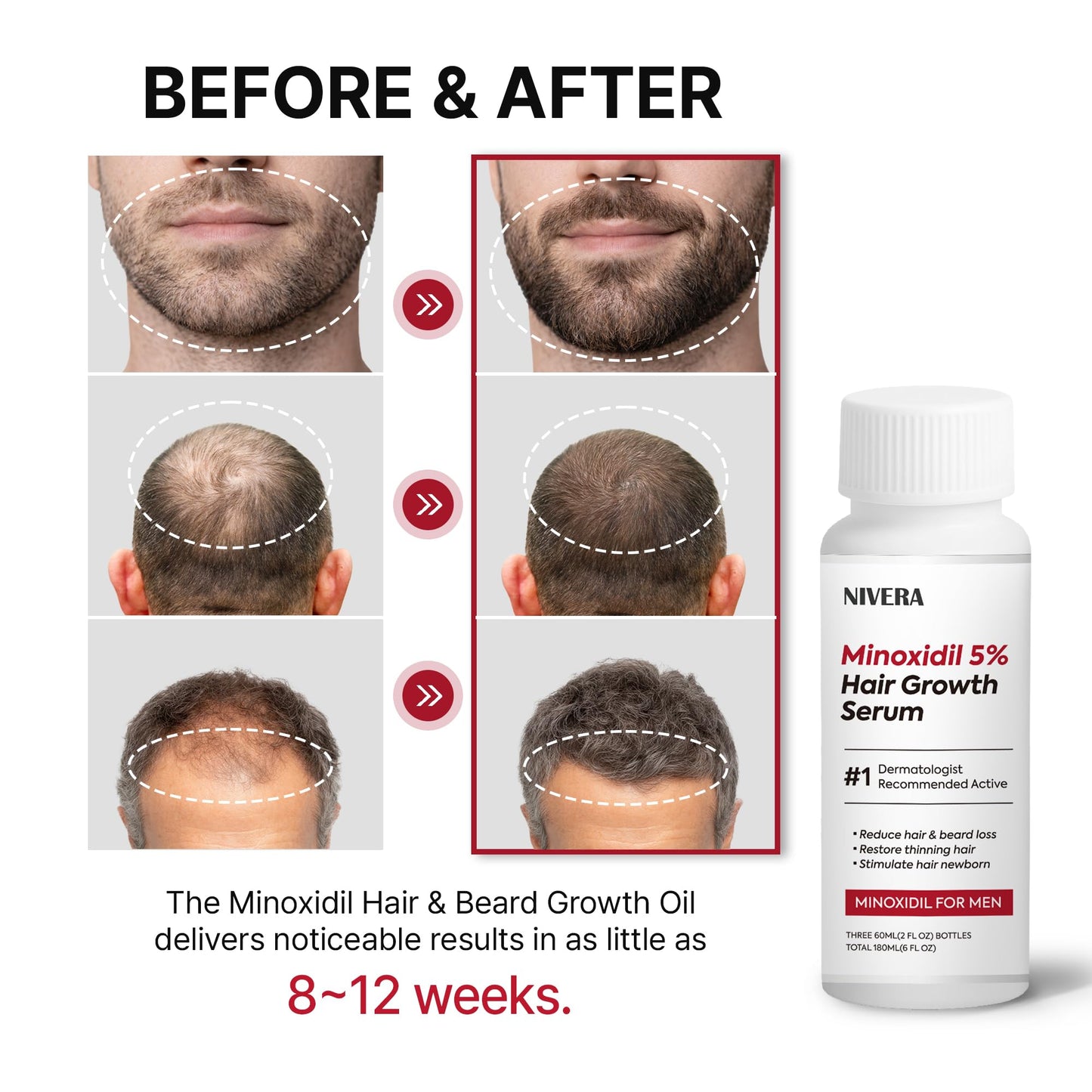 NIVELA 5% Minoxidil for Men Hair Growth: 3 x 60ml Bottles Extra Strength Beard Growth kit - Rapid Regrowth Serum for Thinning Hair Morning/Night Care