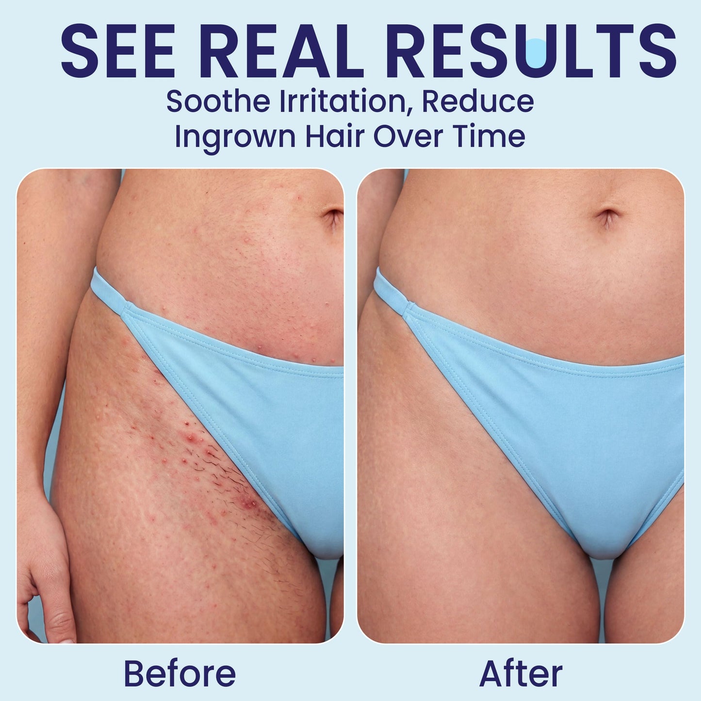 Pearl Ex Ingrown Hair Serum for Smooth Skin – Liquid Exfoliant for Razor Bumps, Dark Spots & Ingrowns – No Scrub Formula – Vegan, Fragrance Free, No Harsh Chemicals – 1 oz