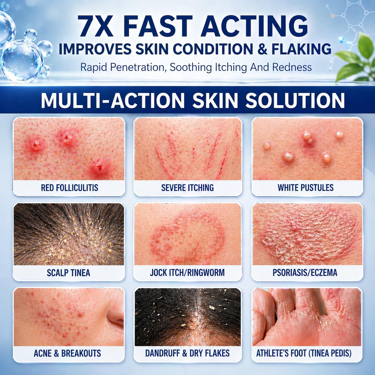 Folliculitis Treatment Cream - 5% Benzoyl Peroxide for Scalp & Body Bumps | Fast Relief for Itching & Redness, 3.53 oz