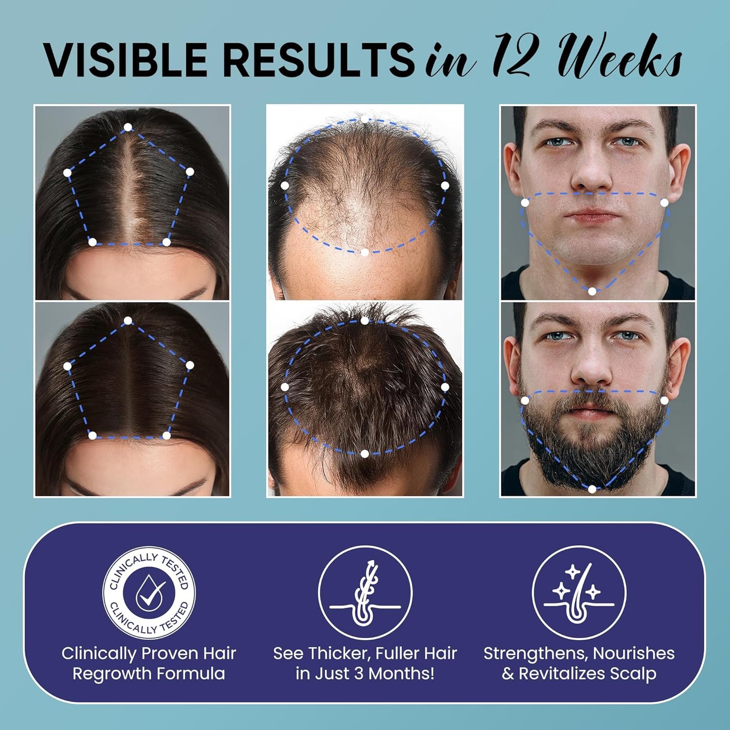 Minoxidil Hair Growth Kit for Men & Women | Regrowth Treatment Serum with Biotin & Rosemary - 2 Pack for Thicker, Stronger Hair