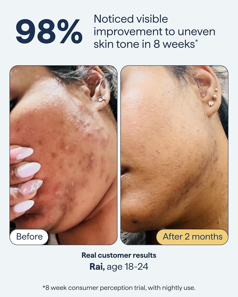 Advanced Discoloration Correcting Serum - Dark Spot Remedy with Retinol & Kojic Acid | Fragrance-Free, 1fl oz