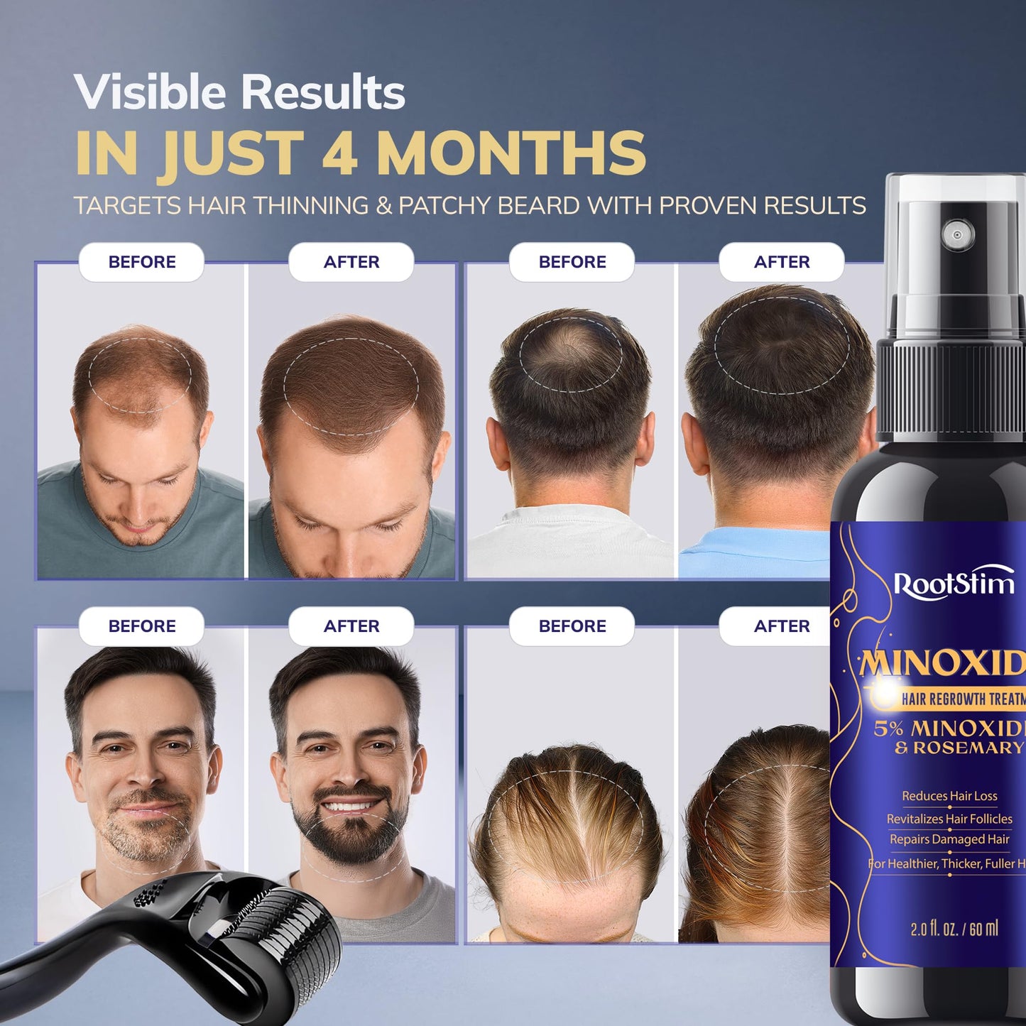 5% Minoxidil Spray + 0.25mm Derma Roller Hair Growth Kit for Men and Women, Hair Regrowth Treatment for Thinning Hairline, Crown & Beard, Rosemary Biotin Formula, 60 mL