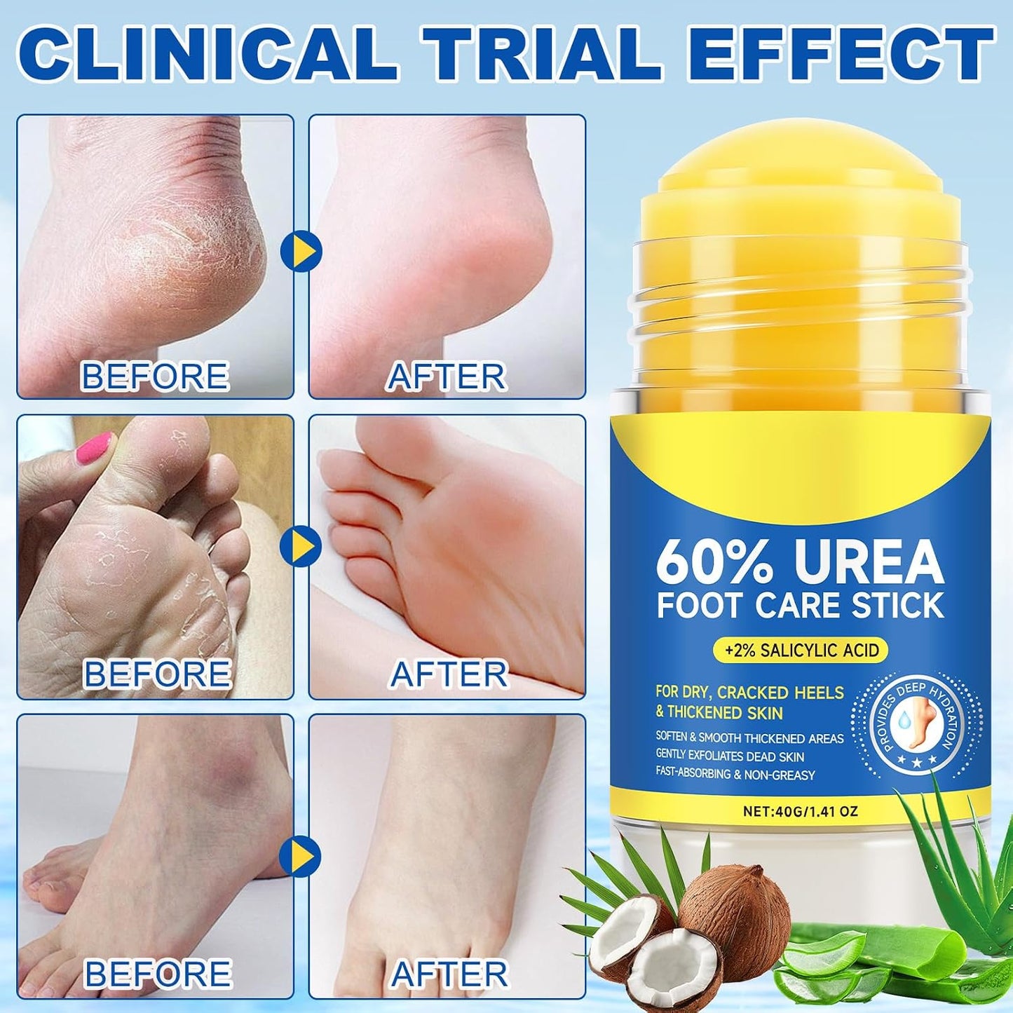 Urea Cream Stick 60% with 2% Salicylic Acid - Extra Strength Foot Cream for Dry Cracked Heels & Callus Removal