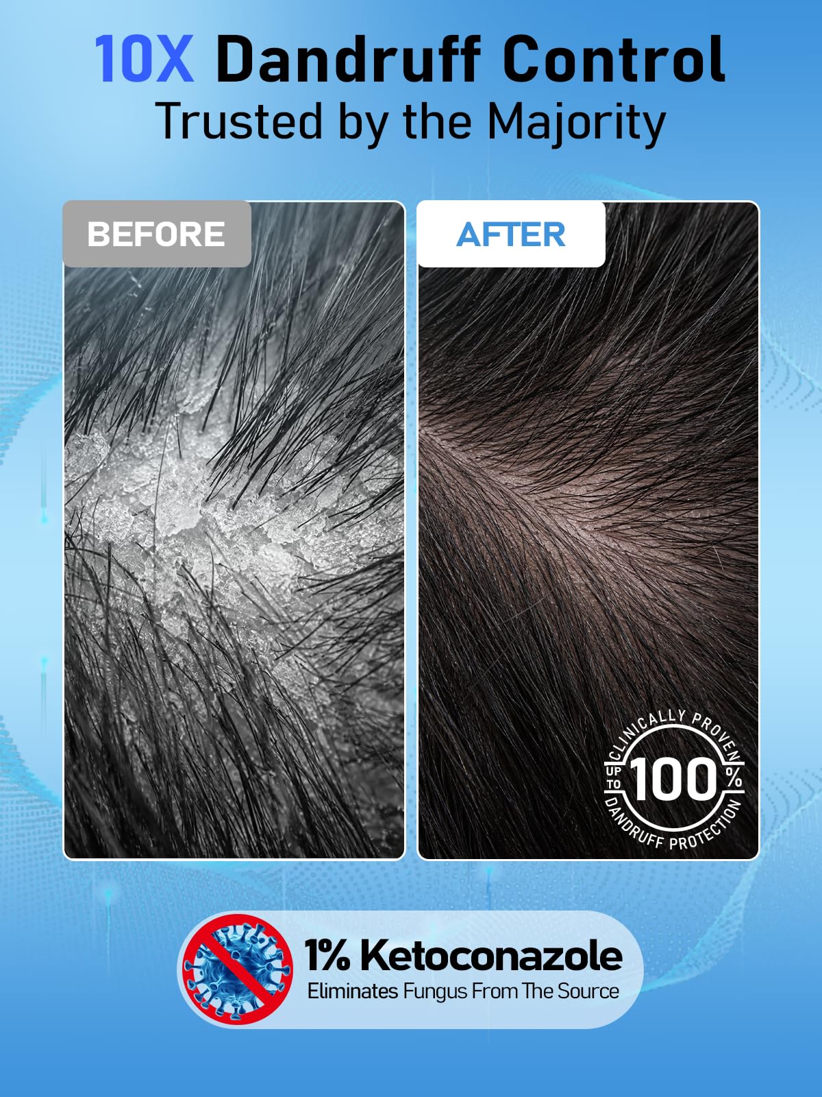 Gembooxt Anti Dandruff Shampoo【10x Dandruff Control】 Ketoconazole Shampoo 1% 【Maximum OTC Strength & Clinically Effective】 for Seborrheic Dermatitis, Itchy Scalp, Antifungal Treatment for Men & Women