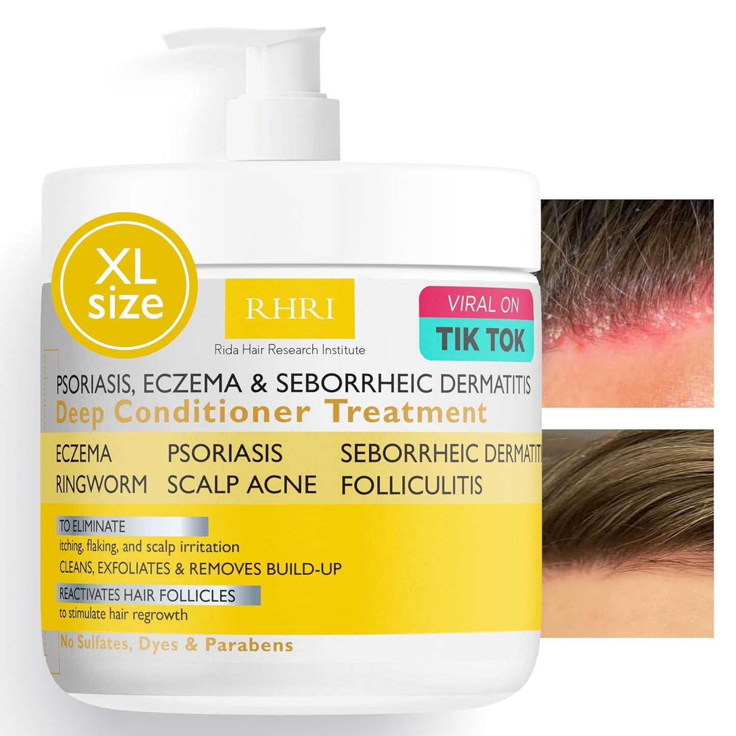 Psoriasis Scalp Spray - Antifungal Treatment for Dandruff, Yeast Infections & Flare-Ups | Soothing Relief for Itchy Scalp