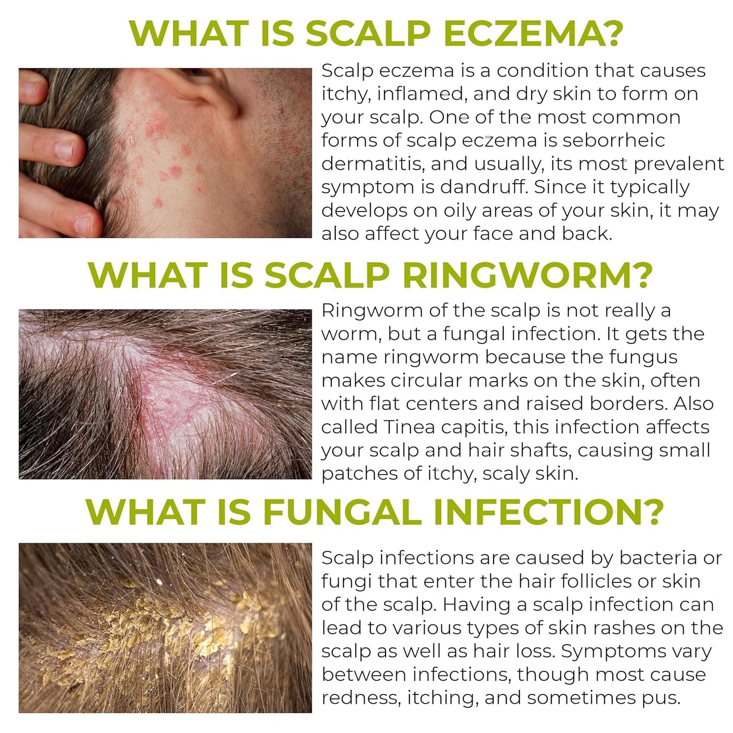Folliculitis Shampoo - Antifungal Treatment for Seborrheic Dermatitis & Scalp Psoriasis | Soothes Itchy, Dry Scalp