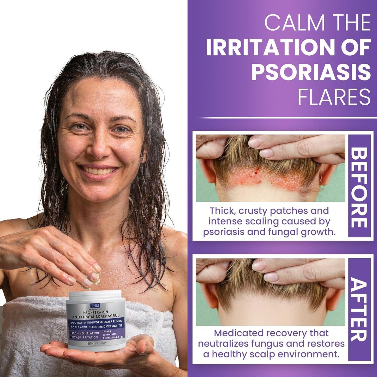 Anti-Fungal Scalp Scrub for Men & Women - Medicated Dandruff Relief for Dry Scalp | Treat Folliculitis, Psoriasis, Ringworm
