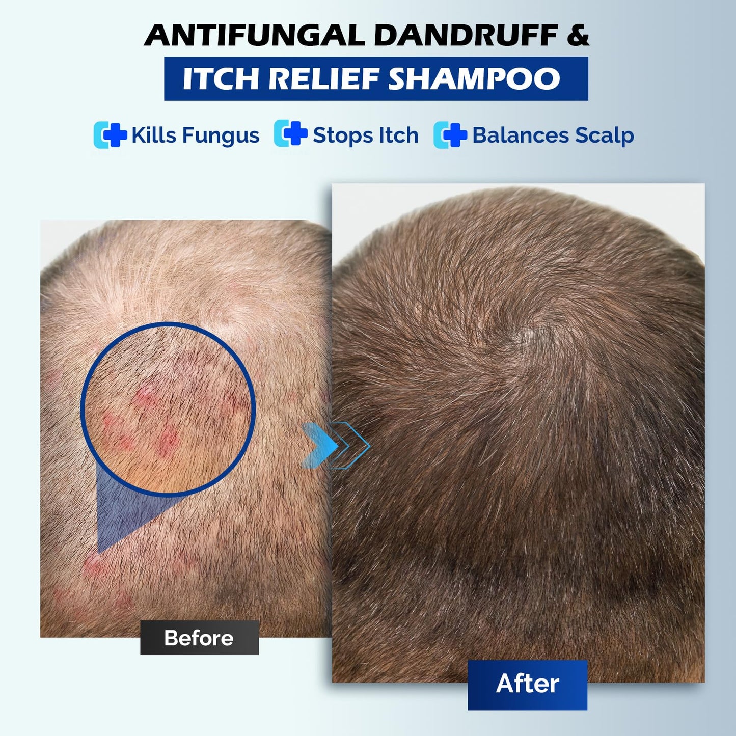 Antifungal Psoriasis Shampoo for Seborrheic Dermatitis, Folliculitis & Scalp Psoriasis, Anti-Dandruff Shampoo for Men & Women, Relieves Scalp Itching, Dryness, Sulfate & Paraben-Free, 10.1 Fl Oz-Fresh
